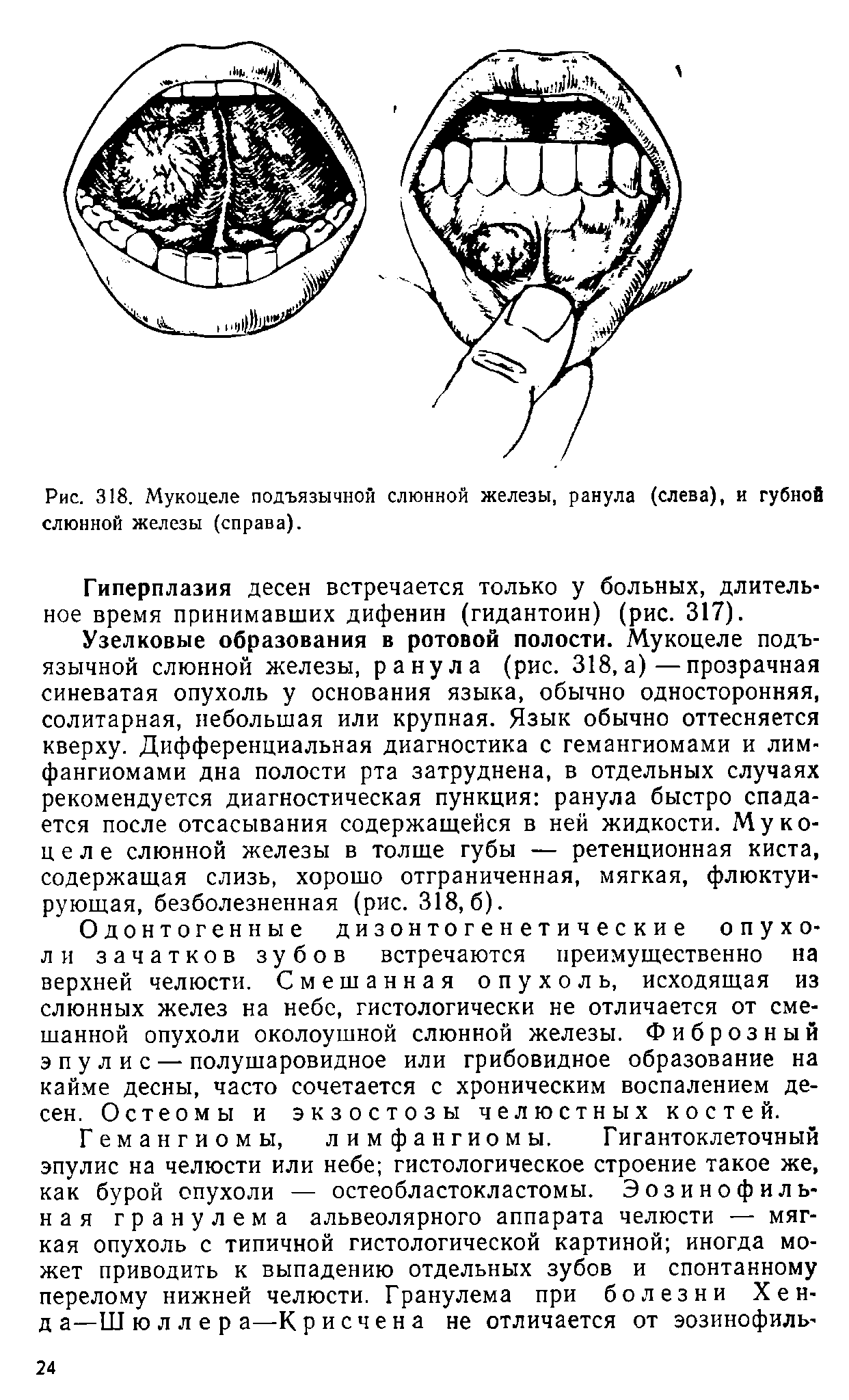 Рис. 318. Мукоцеле подъязычной слюнной железы, ранула (слева), и губной слюнной железы (справа).