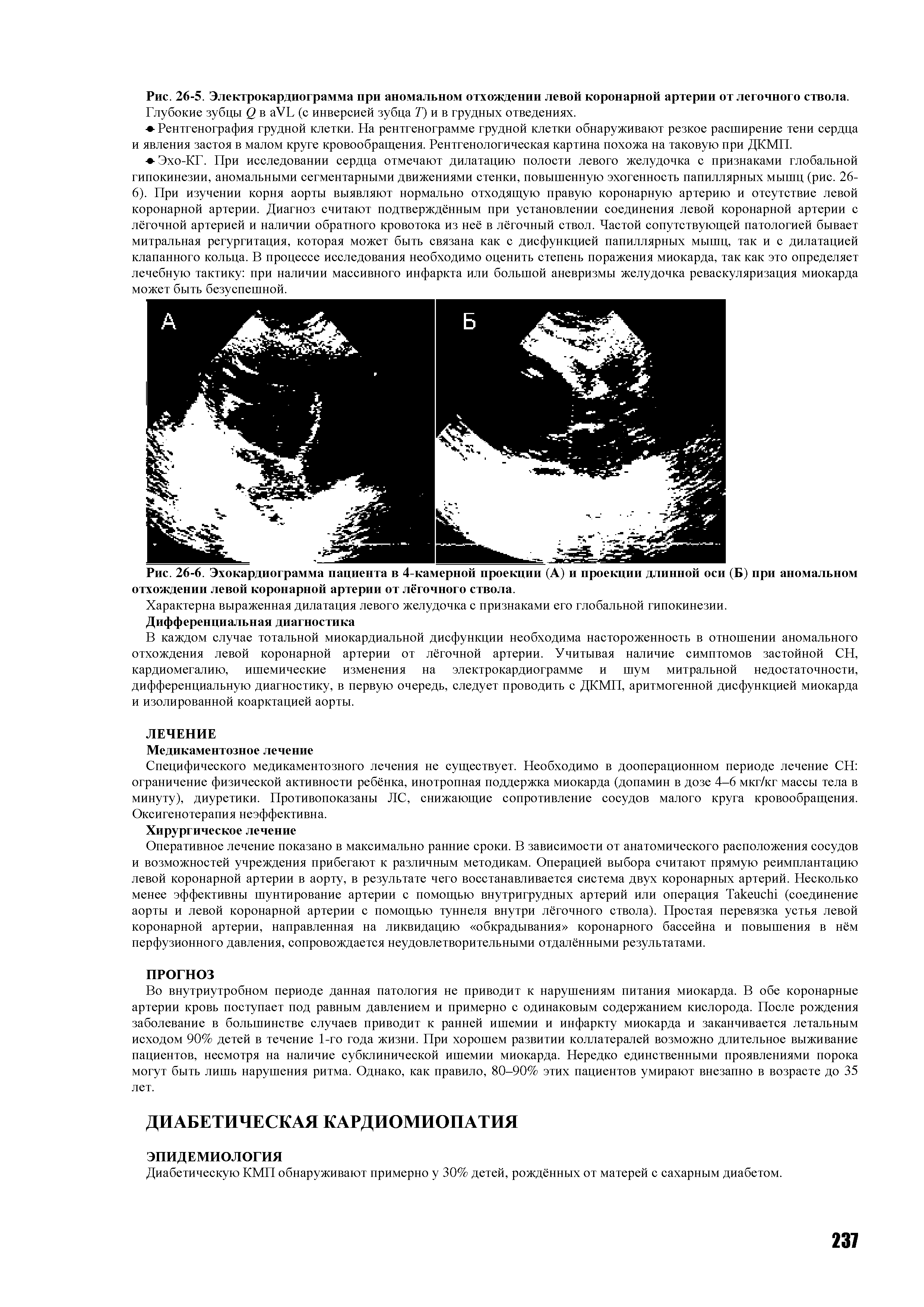 Рис. 26-6. Эхокардиограмма пациента в 4-камерной проекции (А) и проекции длинной оси (Б) при аномальном отхождении левой коронарной артерии от лёгочного ствола.