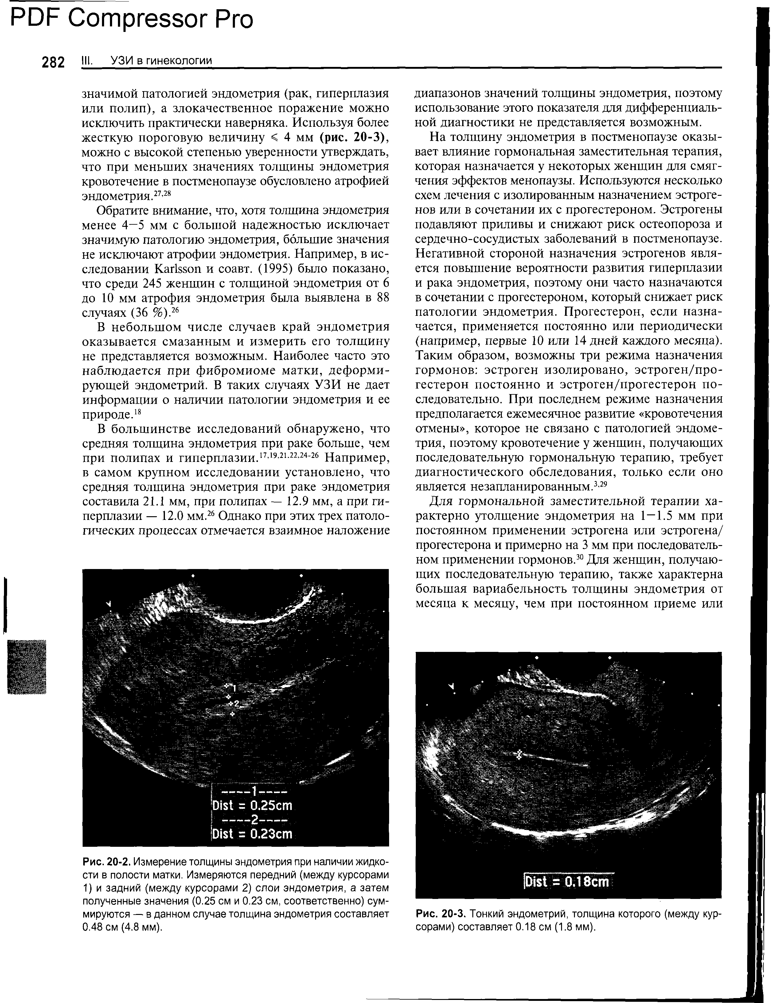 Рис. 20-2. Измерение толщины эндометрия при наличии жидкости в полости матки. Измеряются передний (между курсорами 1) и задний (между курсорами 2) слои эндометрия, а затем полученные значения (0.25 см и 0.23 см, соответственно) суммируются — в данном случае толщина эндометрия составляет 0.48 см (4.8 мм).