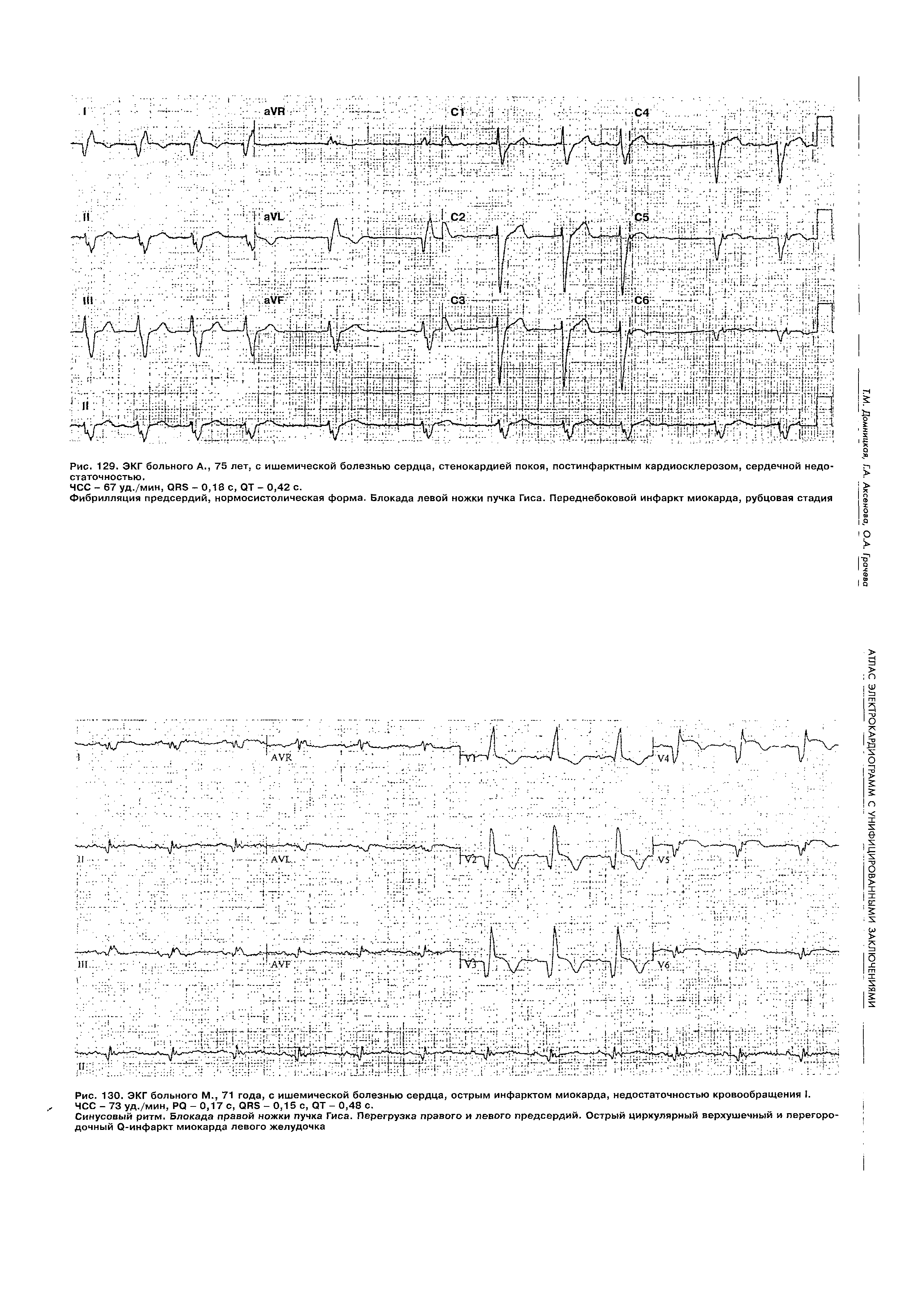 Рис. 130. ЭКГ больного М., 71 года, с ишемической болезнью сердца, острым инфарктом миокарда, недостаточностью кровообращения I. ЧСС - 73 уд./мин, РО - 0,17 с, ОАЭ - 0,15 с, ОТ - 0,48 с.