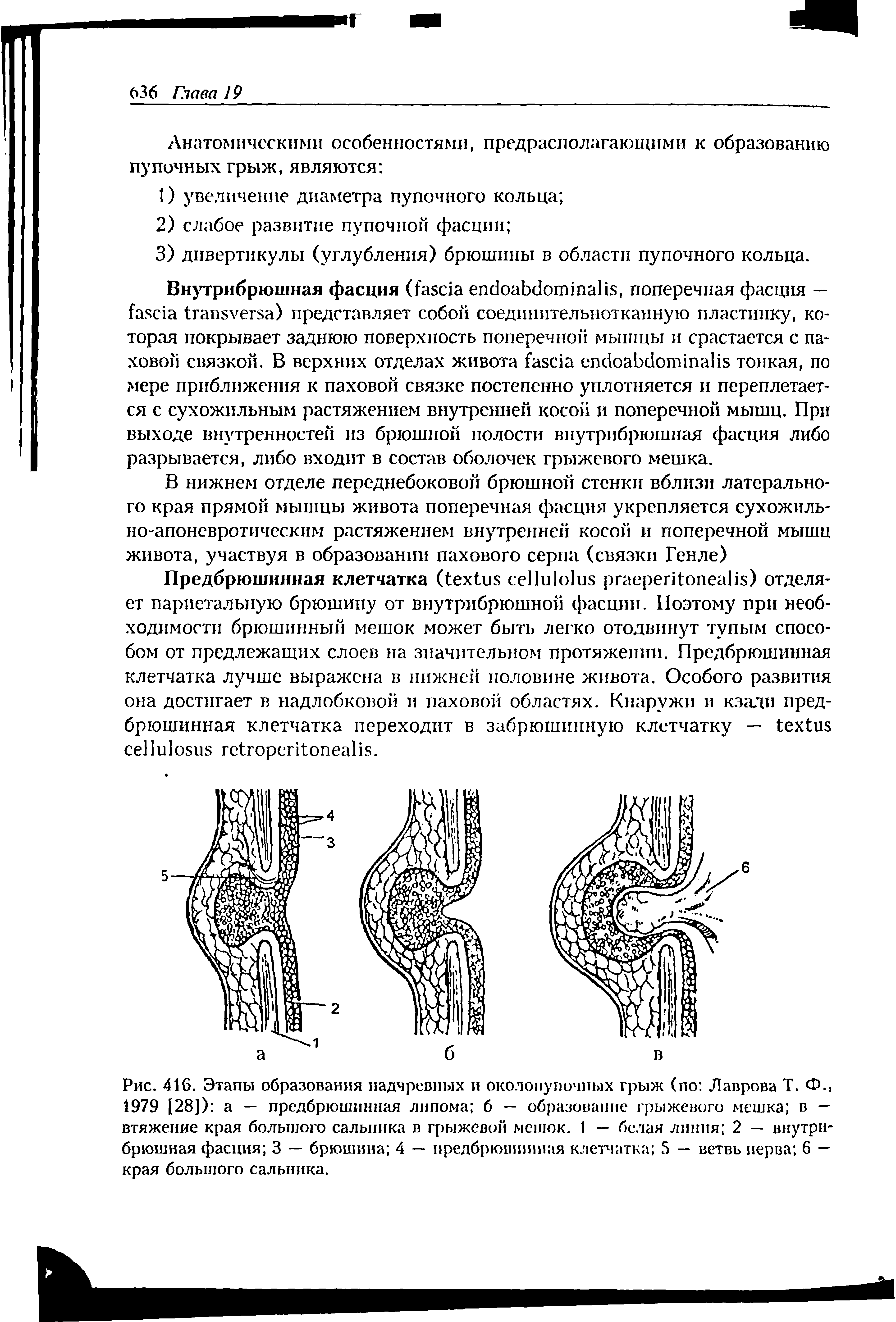 Рис. 416. Этапы образования надчревных и околопупочных грыж (по Лаврова Т. Ф. 1979 [28]) а — предбрюшиниая липома 6 — образование грыжевого мешка в — втяжение края большого сальника в грыжевой мешок. 1 — белая линия 2 — внутрибрюшная фасция 3 — брюшина 4 — предбрюшиниая клетчатка 5 — ветвь нерва 6 — края большого сальника.