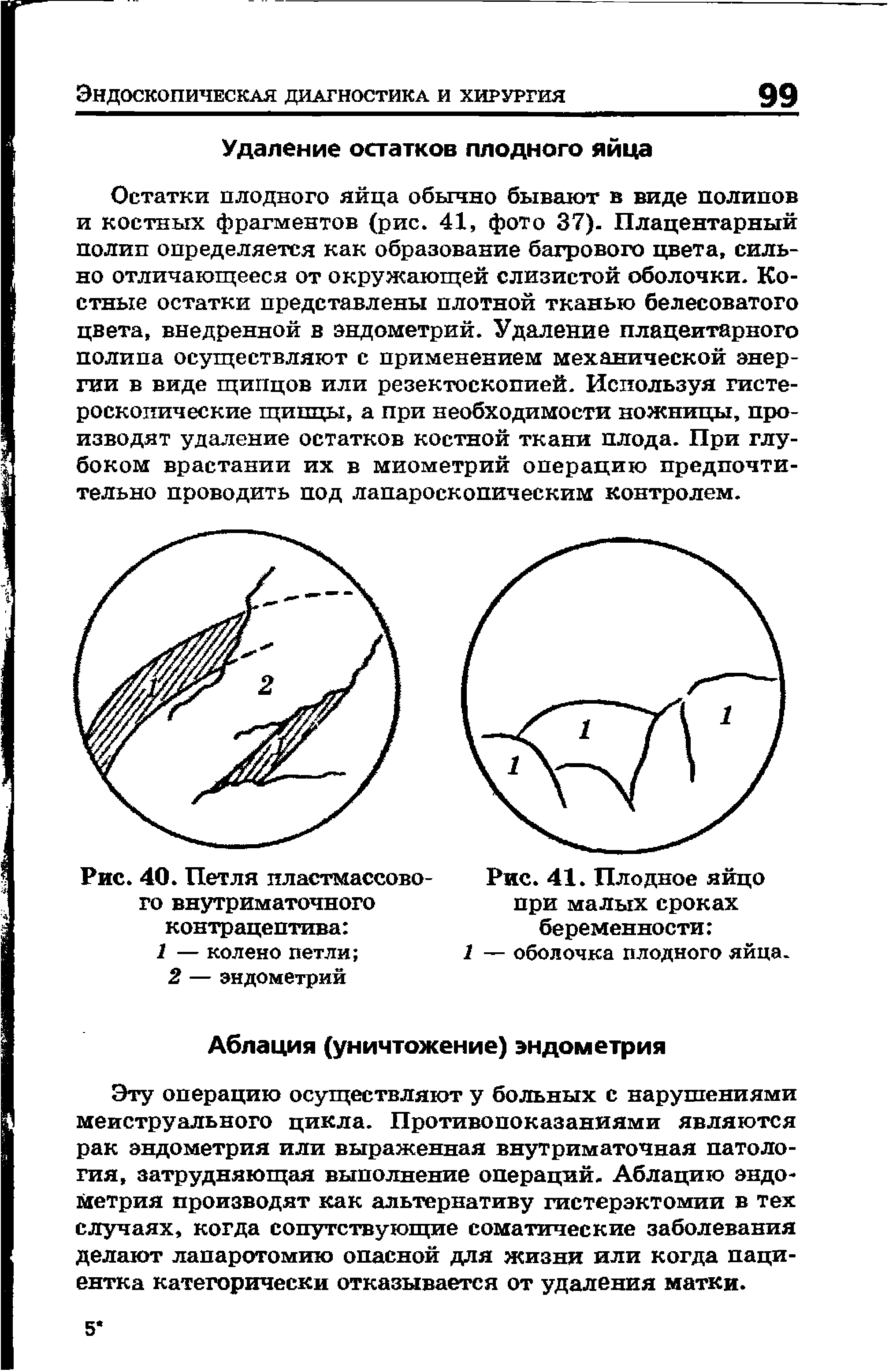 Рис. 40. Петля пластмассового внутриматочного контрацептива 1 — колено петли ...