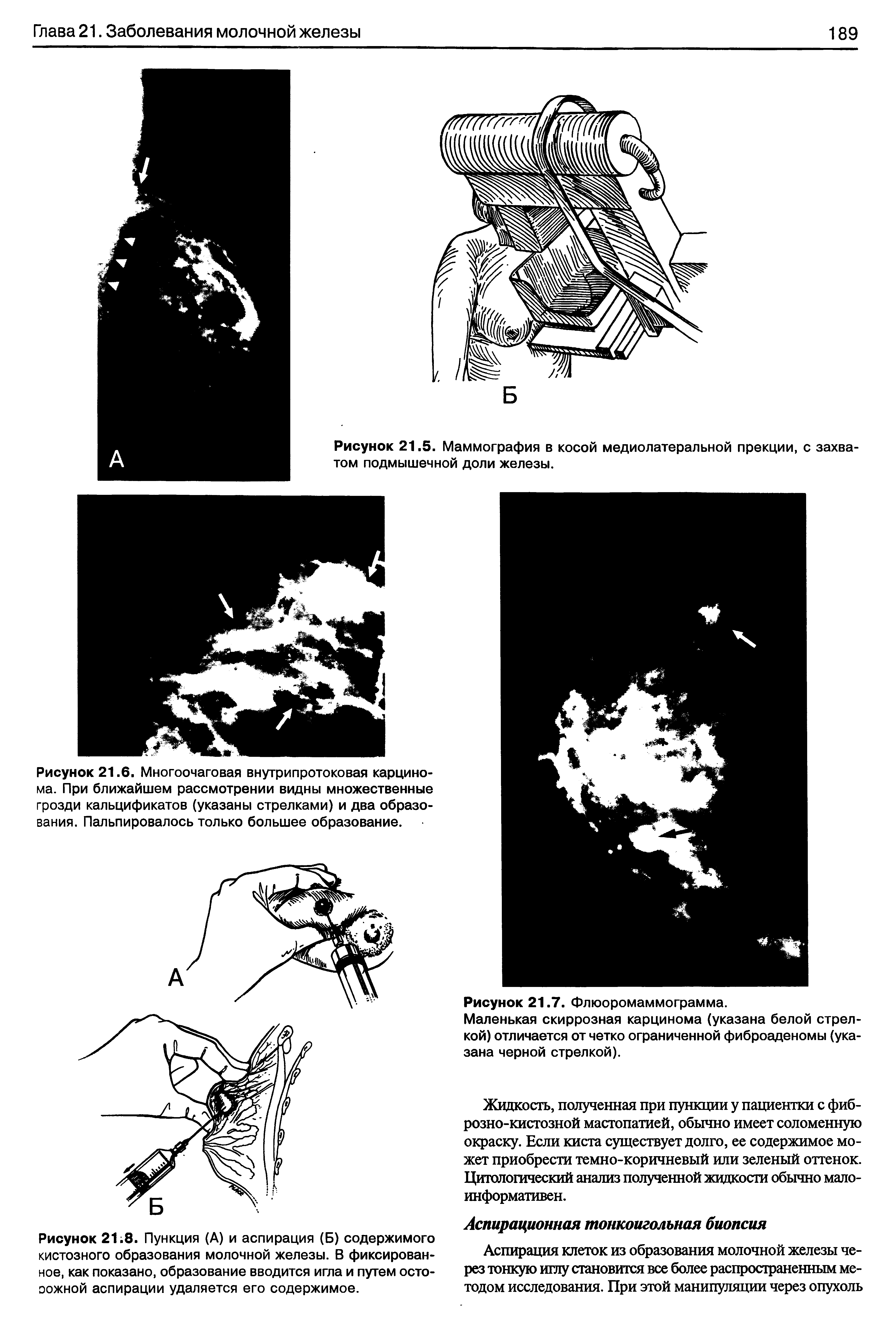 Рисунок 21 8. Пункция (А) и аспирация (Б) содержимого кистозного образования молочной железы. В фиксированное, как показано, образование вводится игла и путем осто-оожной аспирации удаляется его содержимое.
