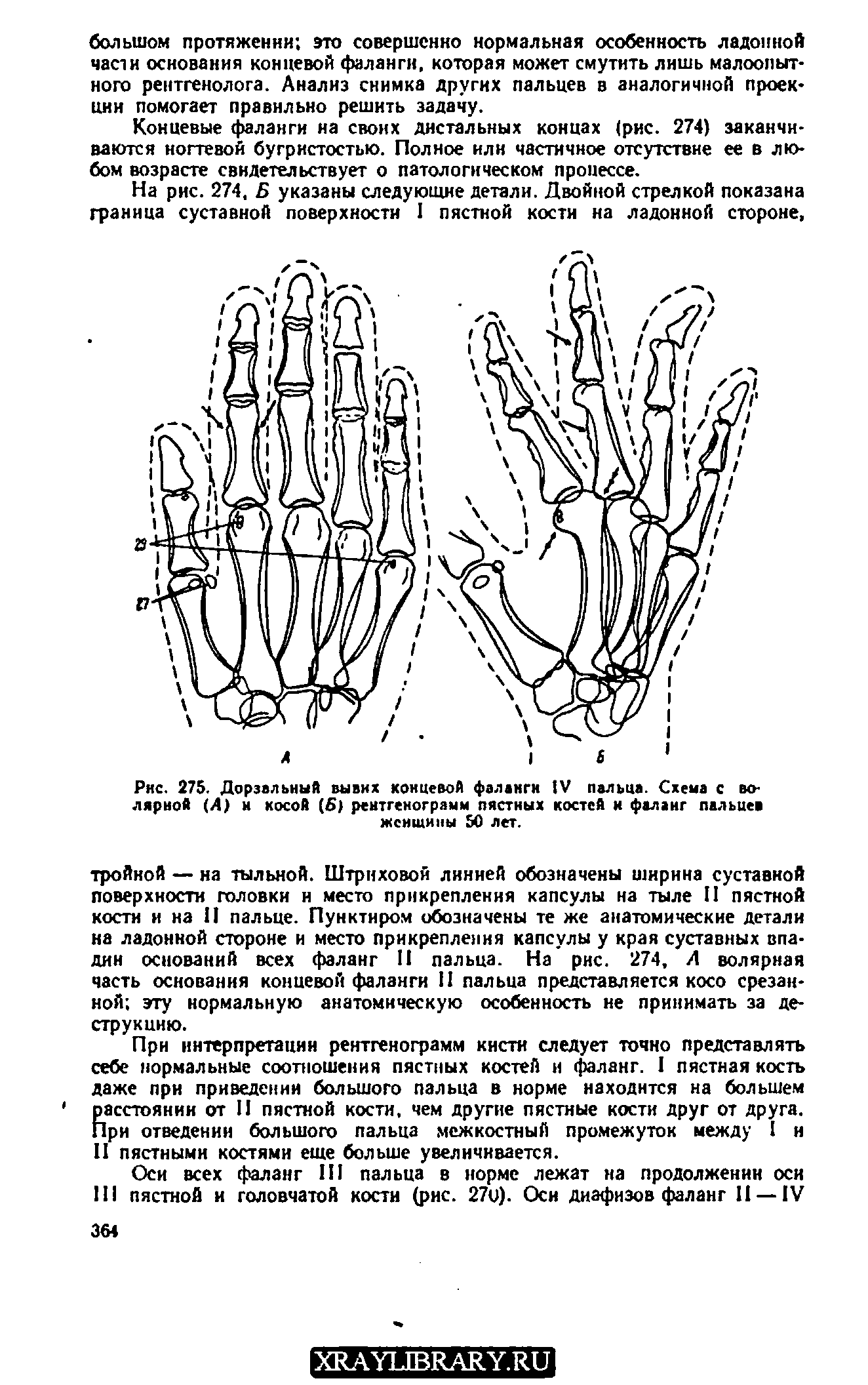 Рис. 275. Дорзальный вывих концевой фаланги IV пальца. Схема с во лярной (Л) и косой (5) рентгенограмм пястных костей и фаланг пальцев женщины 50 лет.