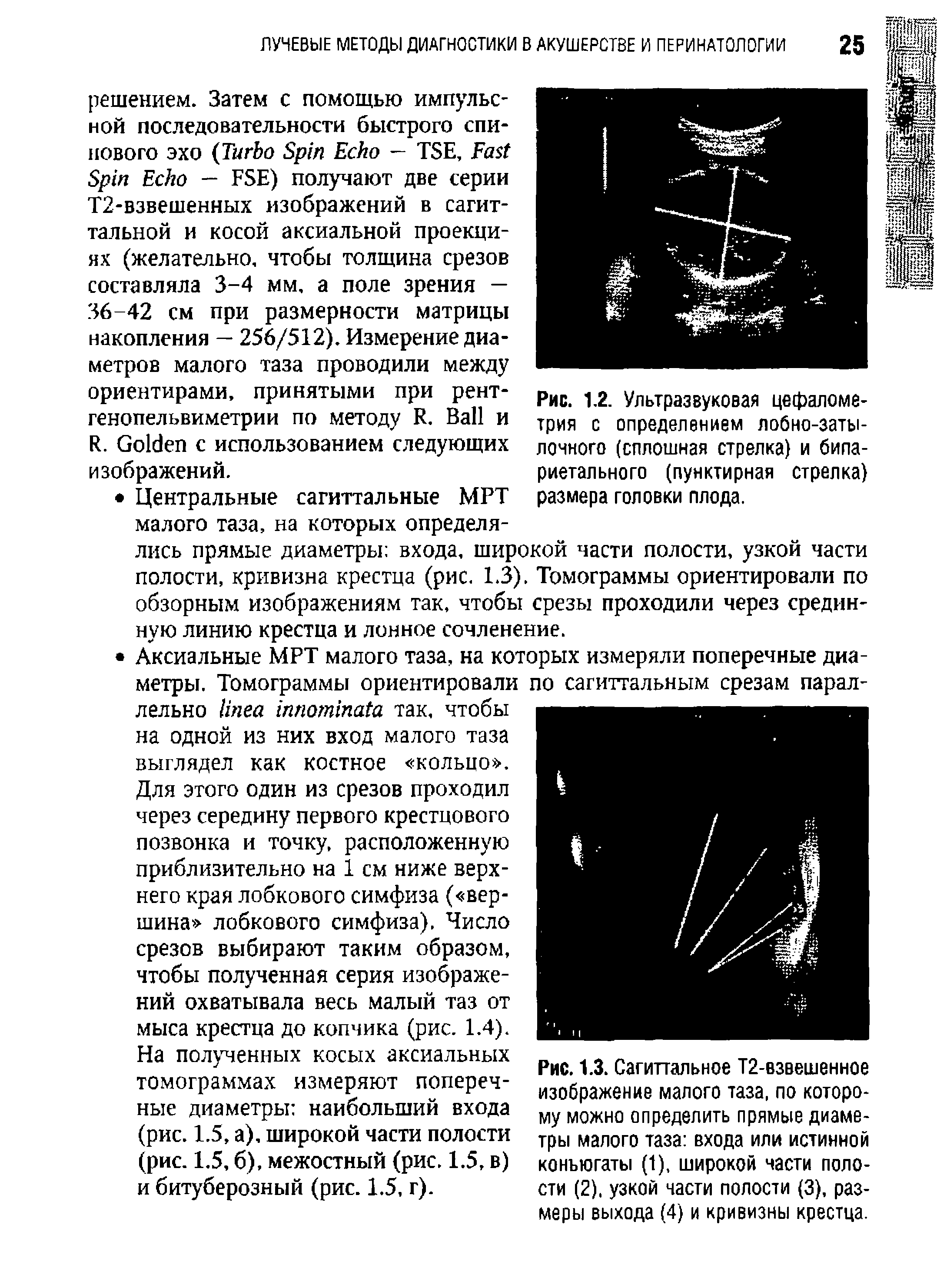 Рис. 1.3. Сагиттальное Т2-взвешенное изображение малого таза, по которому можно определить прямые диаметры малого таза входа или истинной конъюгаты (1), широкой части полости (2), узкой части полости (3), размеры выхода (4) и кривизны крестца.