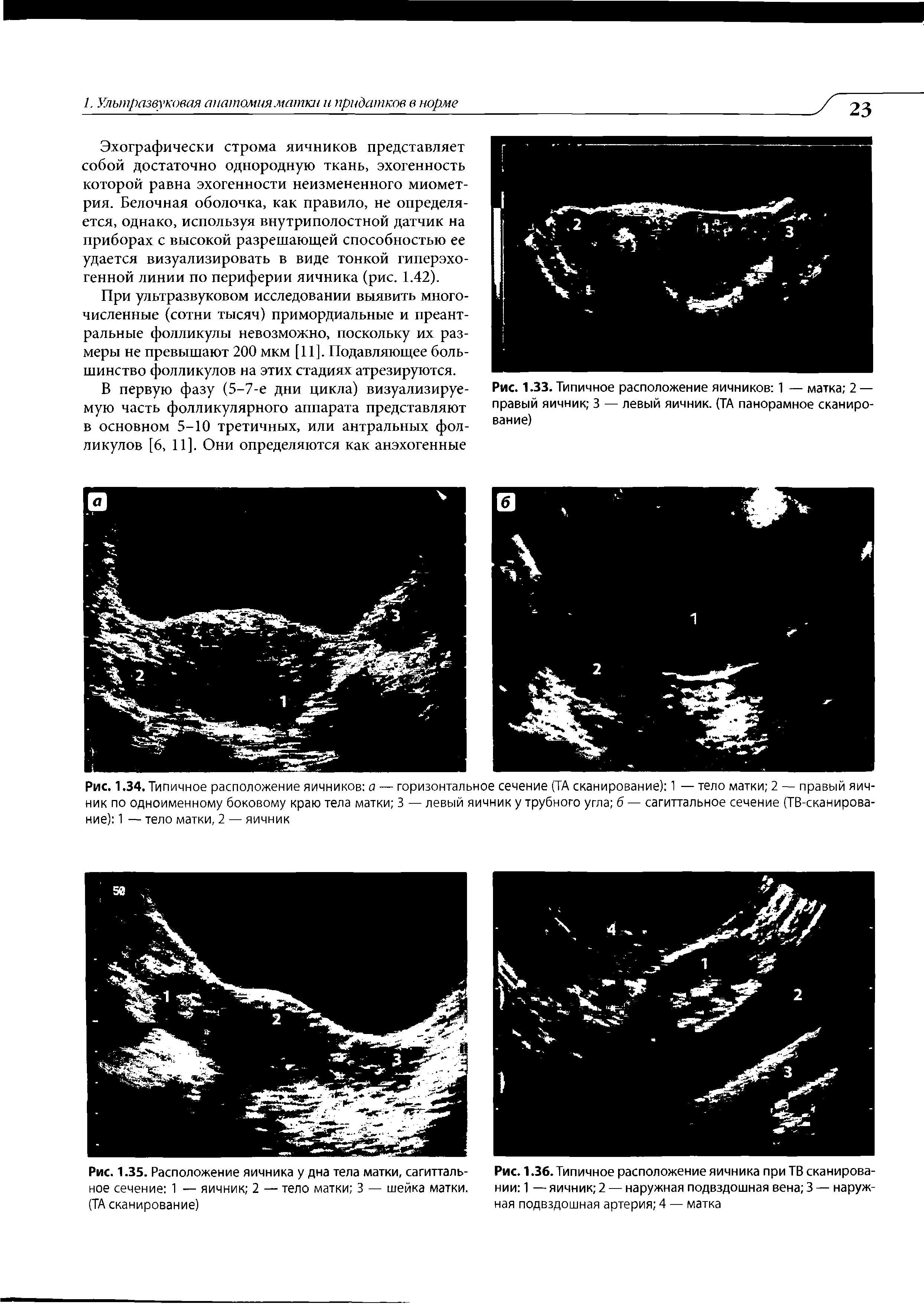 Рис. 1.36. Типичное расположение яичника при ТВ сканировании 1 — яичник 2 — наружная подвздошная вена 3 — наружная подвздошная артерия 4 — матка...