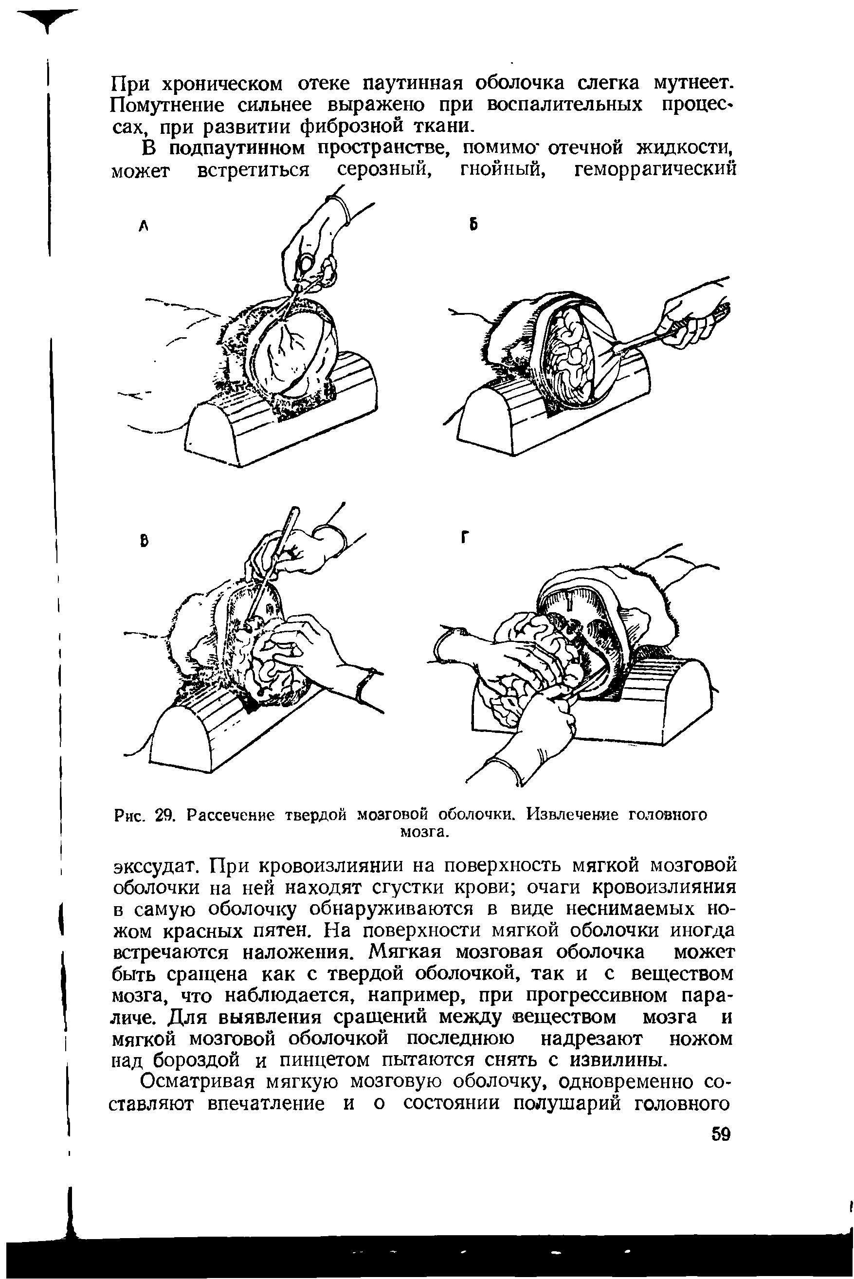 Рис. 29. Рассечение твердой мозговой оболочки. Извлечение головного мозга.