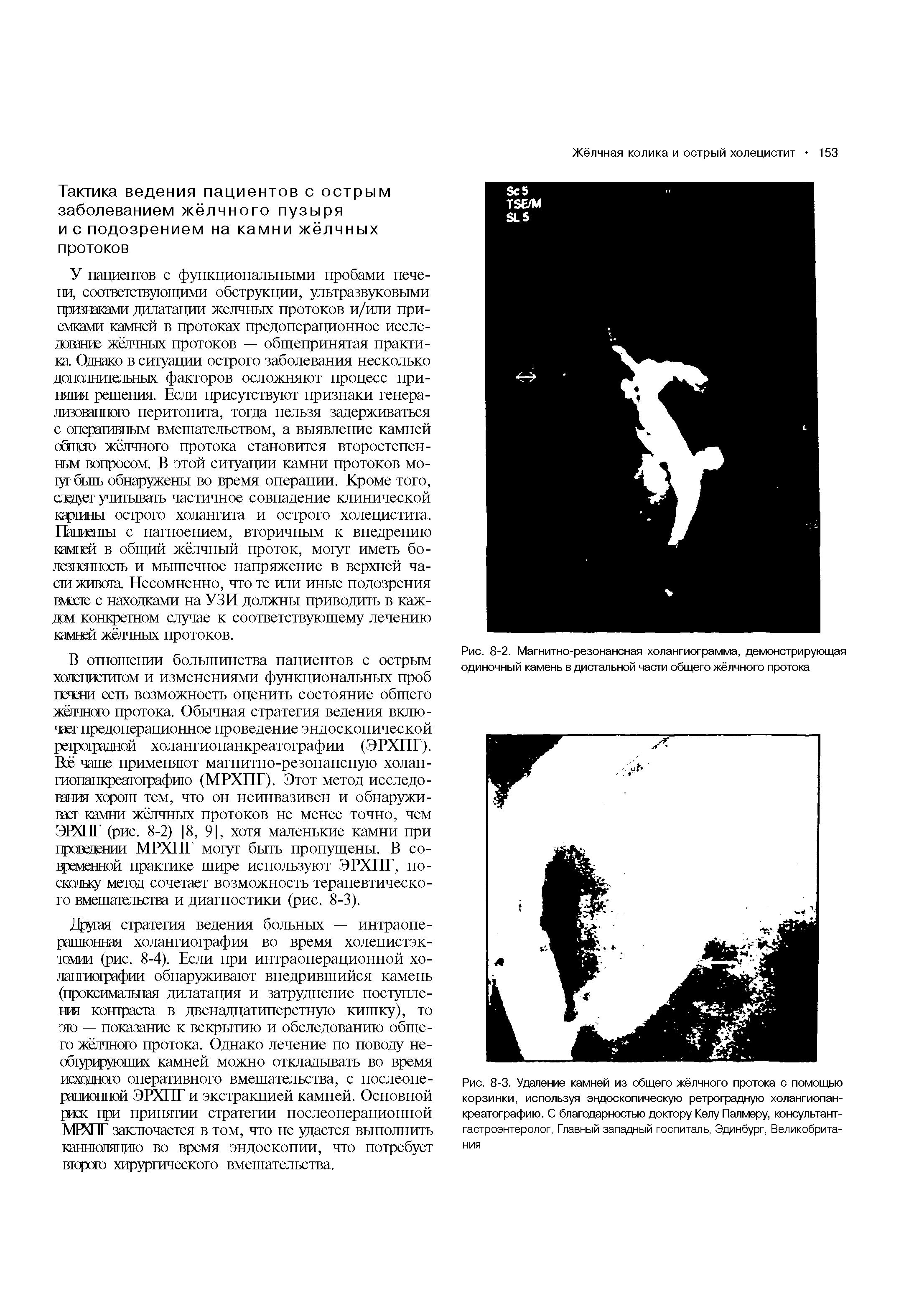 Рис. 8-2. Магнитно-резонансная холангиограмма, демонстрирующая одиночный камень в дистальной части общего жёлчного протока...