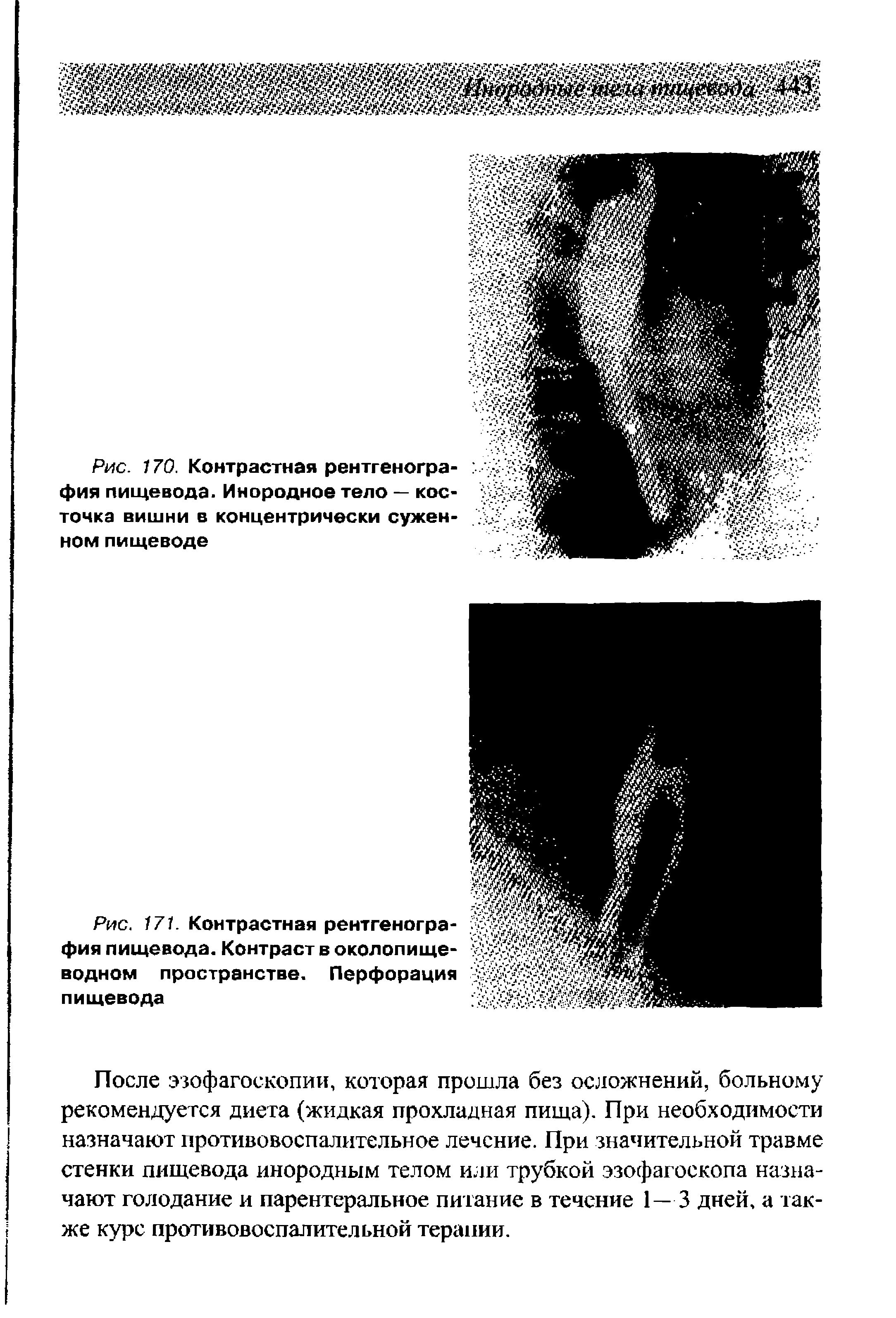 Рис. 171. Контрастная рентгенография пищевода. Контраст в околопище-водном пространстве. Перфорация пищевода...