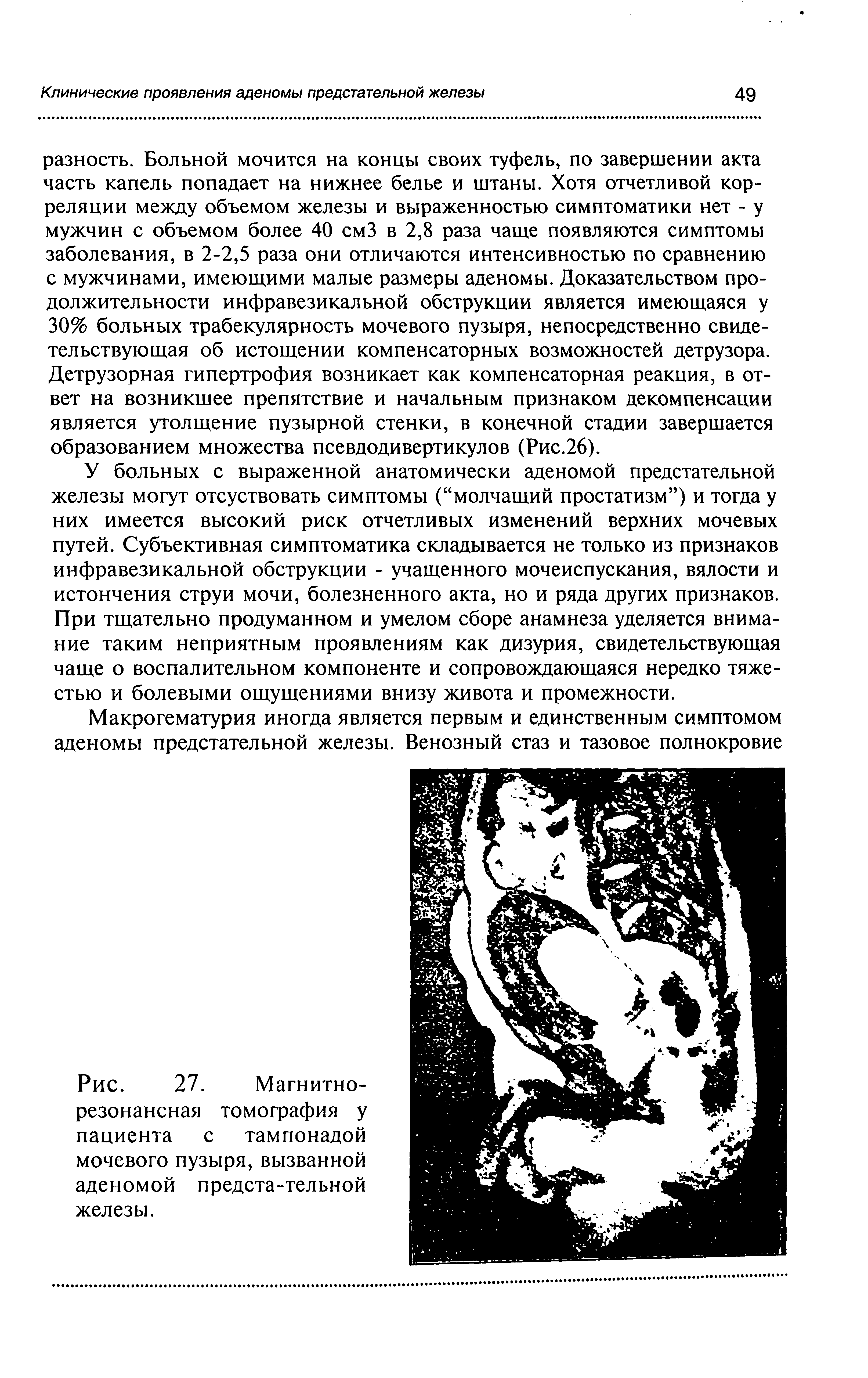 Рис. 27. Магнитно-резонансная томография у пациента с тампонадой мочевого пузыря, вызванной аденомой предста-тельной железы.