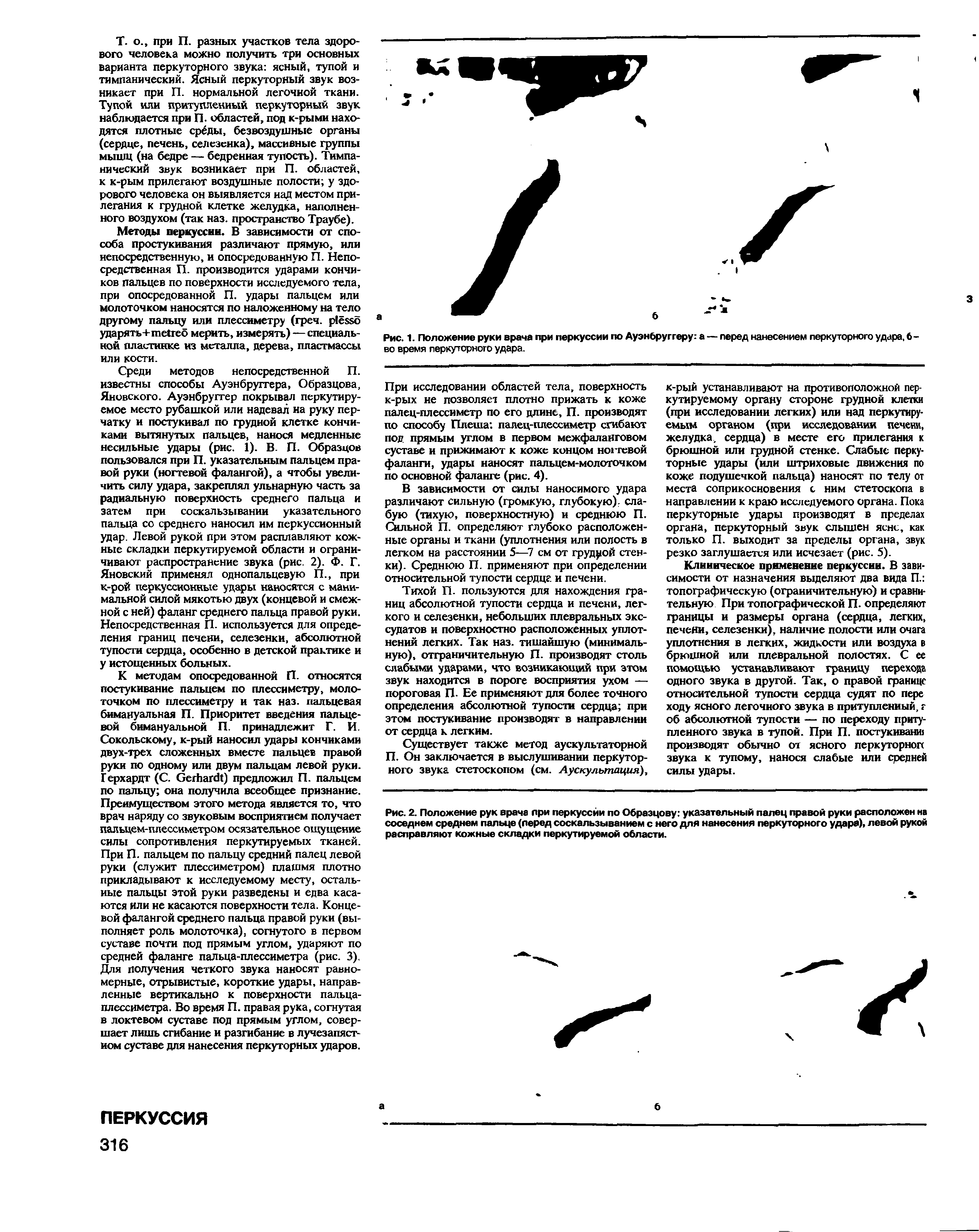 Рис. 1. Положение руки врача при перкуссии по Ауэнбруггеру а — перед нанесением перкуторного удара, б-во время перкуторного удара.