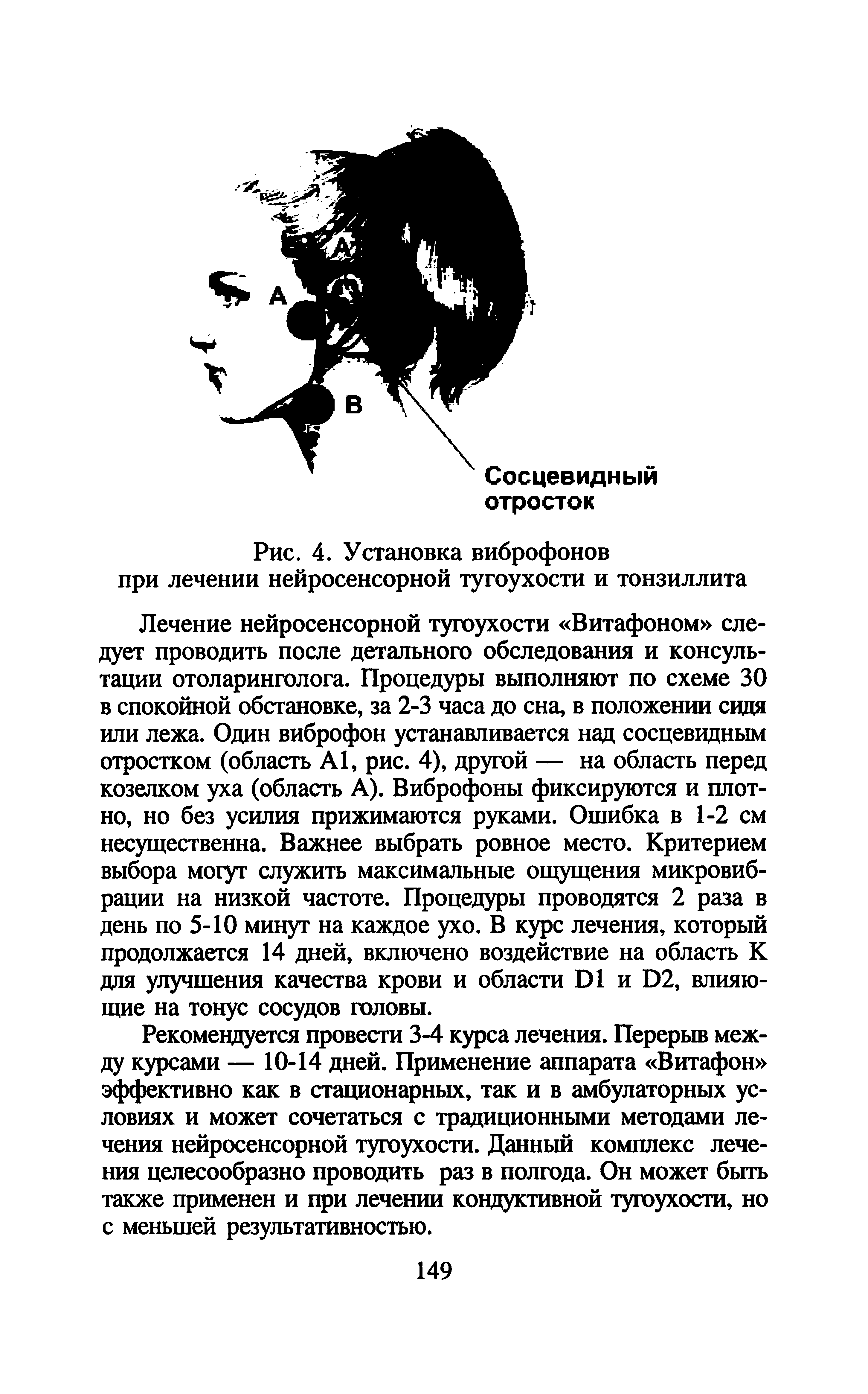 Рис. 4. Установка виброфонов при лечении нейросенсорной тугоухости и тонзиллита...