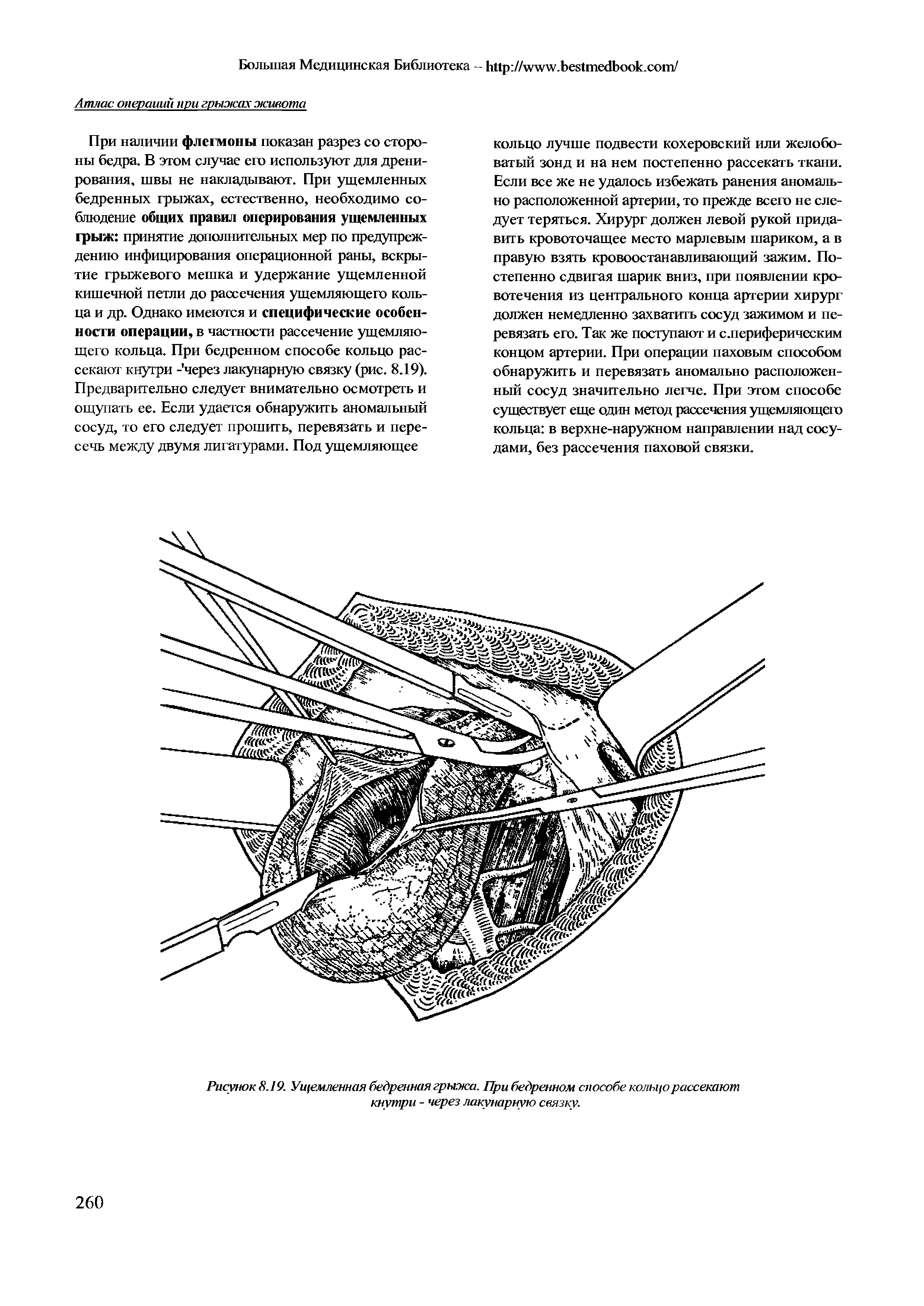 Рисунок 8.19. Ущемленная бедренная грыжа. При бедренном способе кольцо рассекают кнутри - через лакунарную связку.