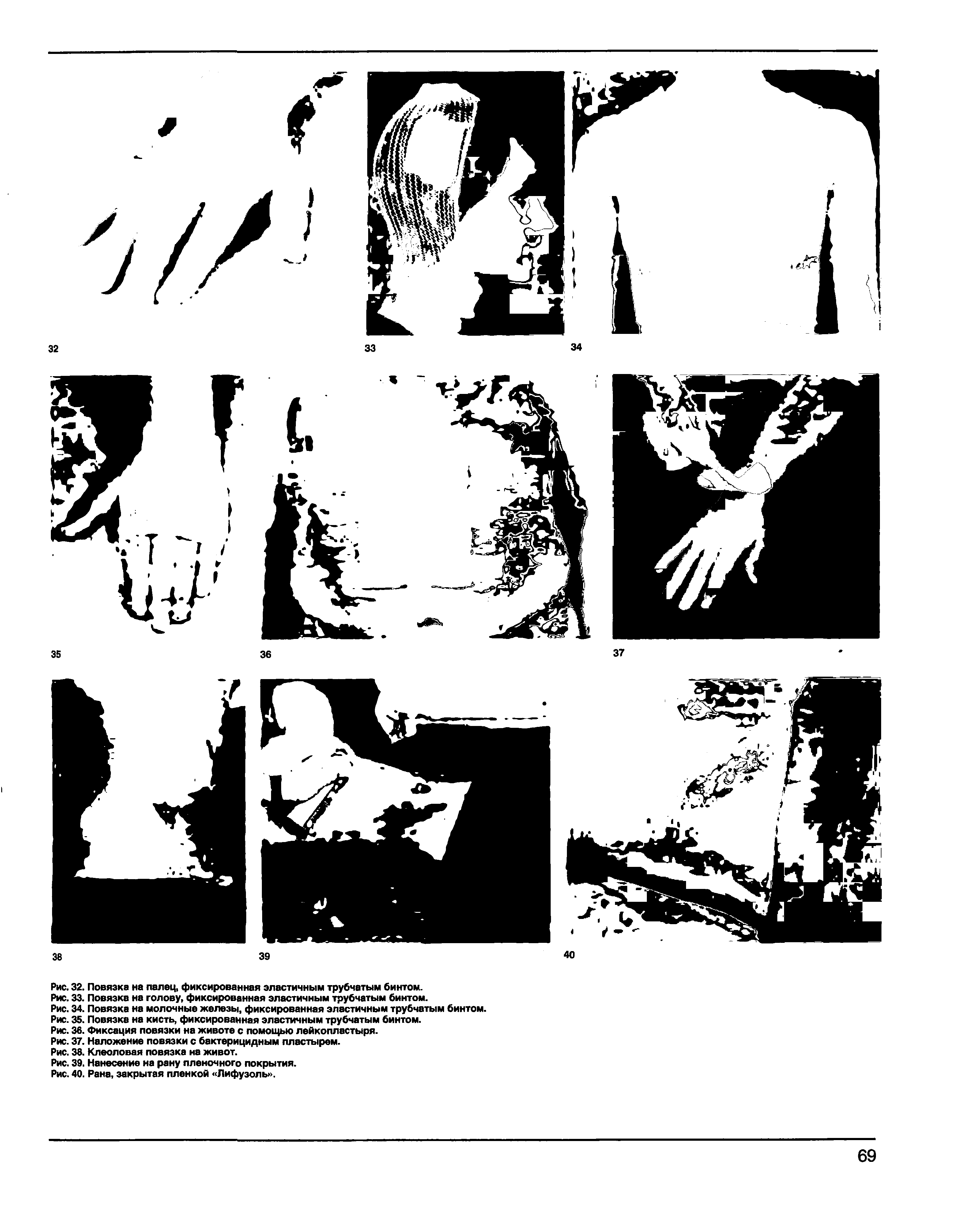 Рис. 35. Повязка на кисть, фиксированная эластичным трубчатым бинтом.