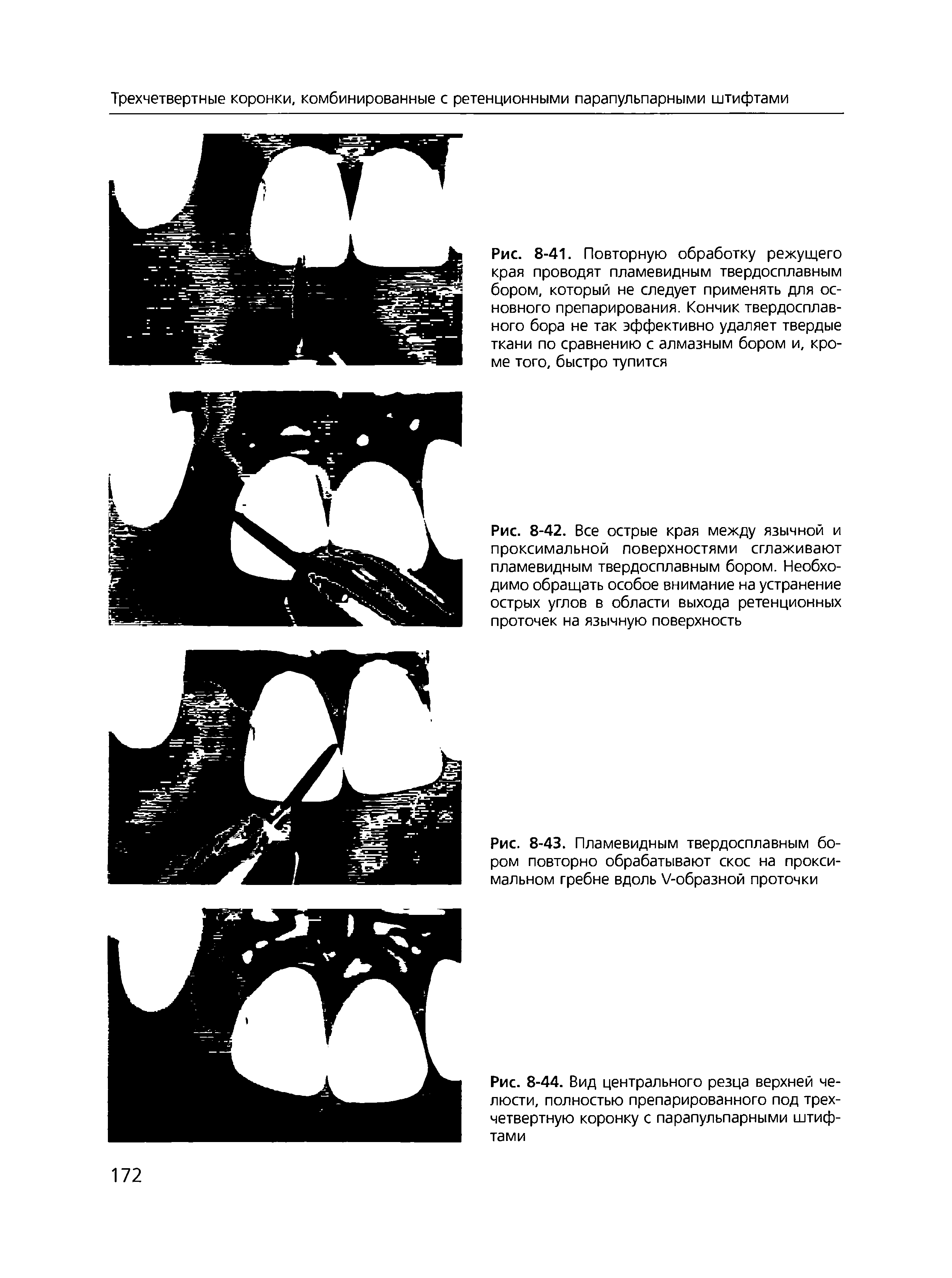 Рис. 8-41. Повторную обработку режущего края проводят пламевидным твердосплавным бором, который не следует применять для основного препарирования. Кончик твердосплавного бора не так эффективно удаляет твердые ткани по сравнению с алмазным бором и, кроме того, быстро тупится...