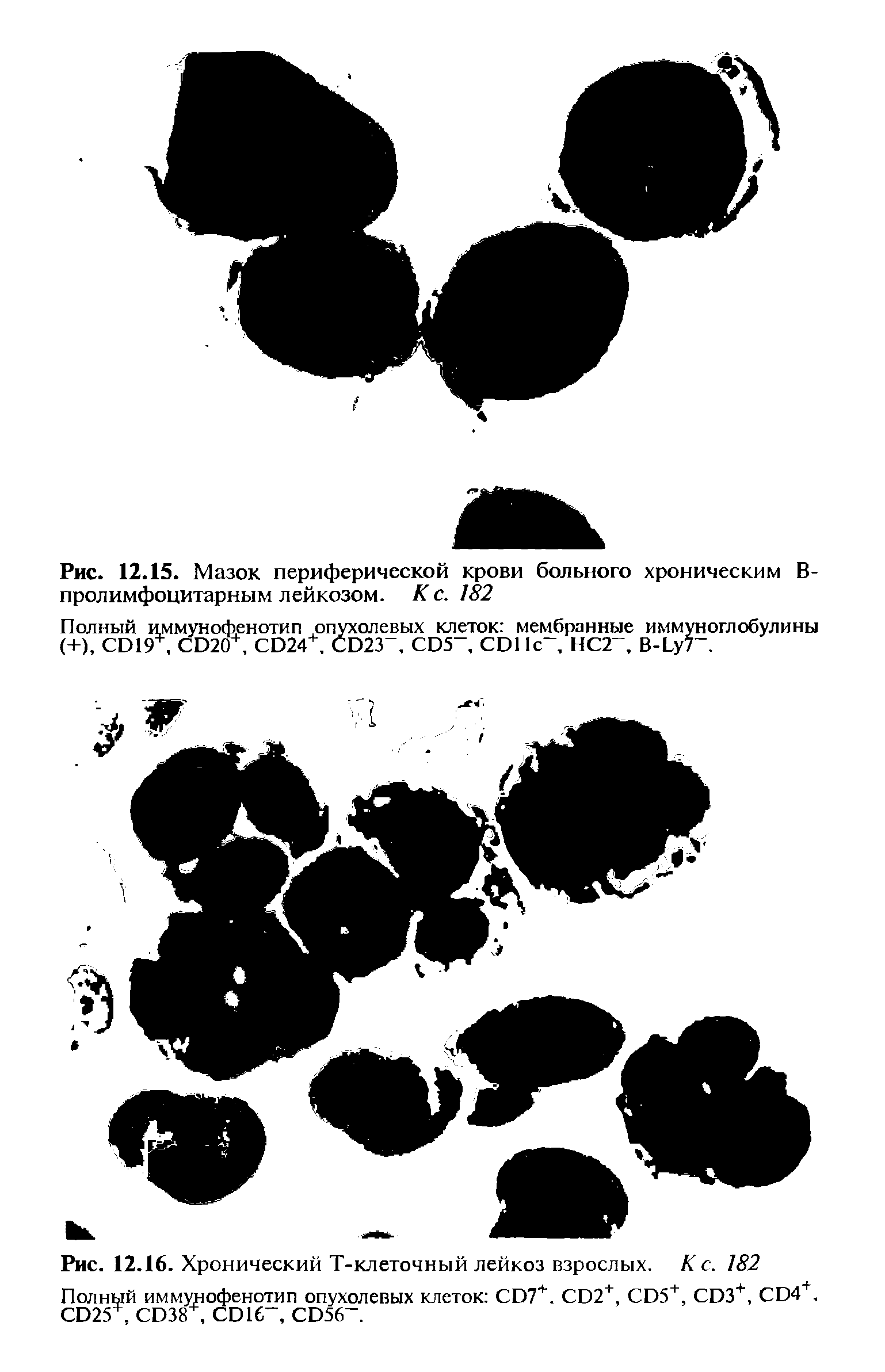 Рис. 12.16. Хронический Т-клеточный лейкоз взрослых. К с. 182 Полный иммунофенотип опухолевых клеток CD7+. CD2+, CD5+, CD3+, CD4+, CD25 CD3 , CD16, CD56. ...