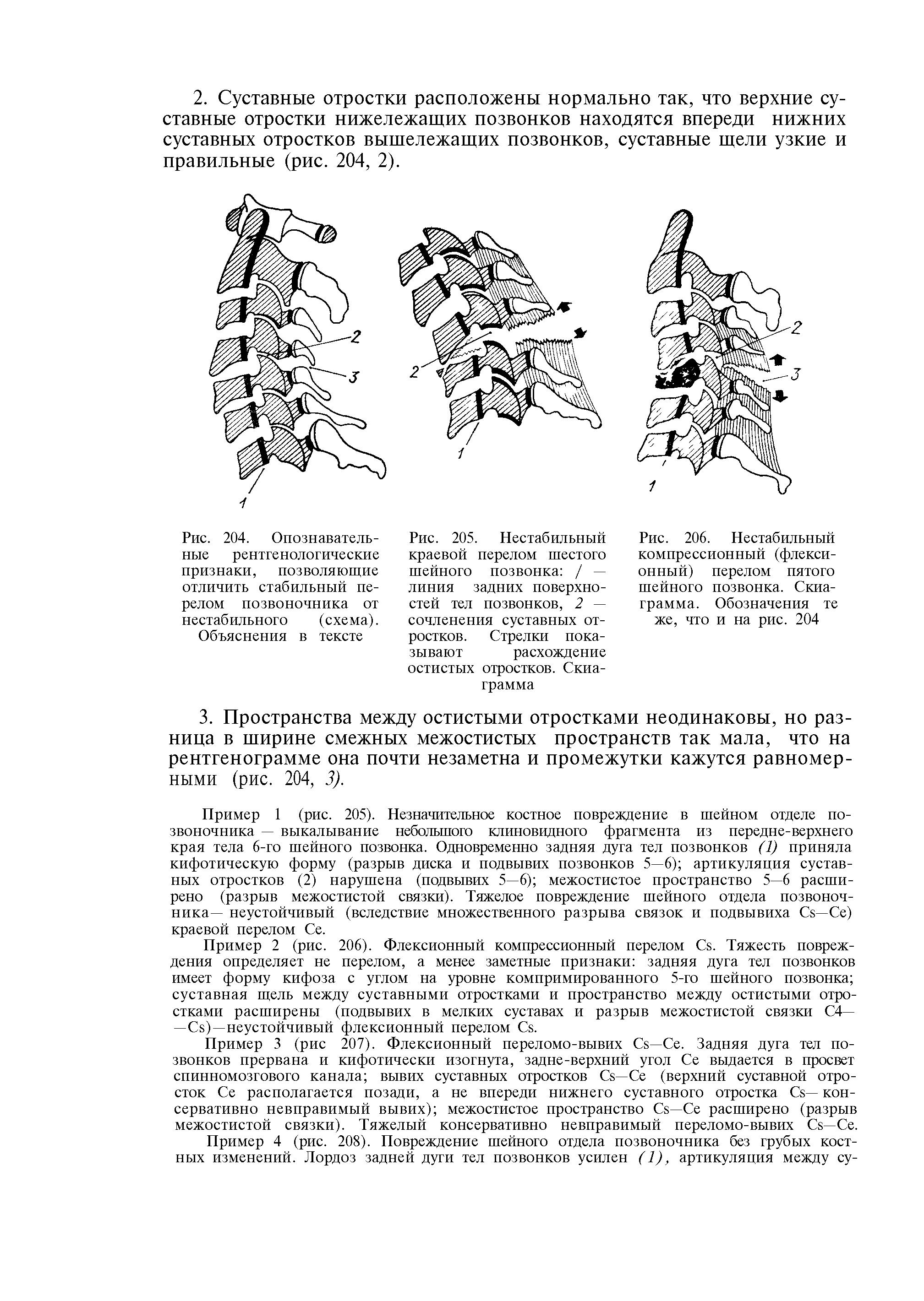 Рис. 206. Нестабильный компрессионный (флексионный) перелом пятого шейного позвонка. Скиаграмма. Обозначения те же, что и на рис. 204...