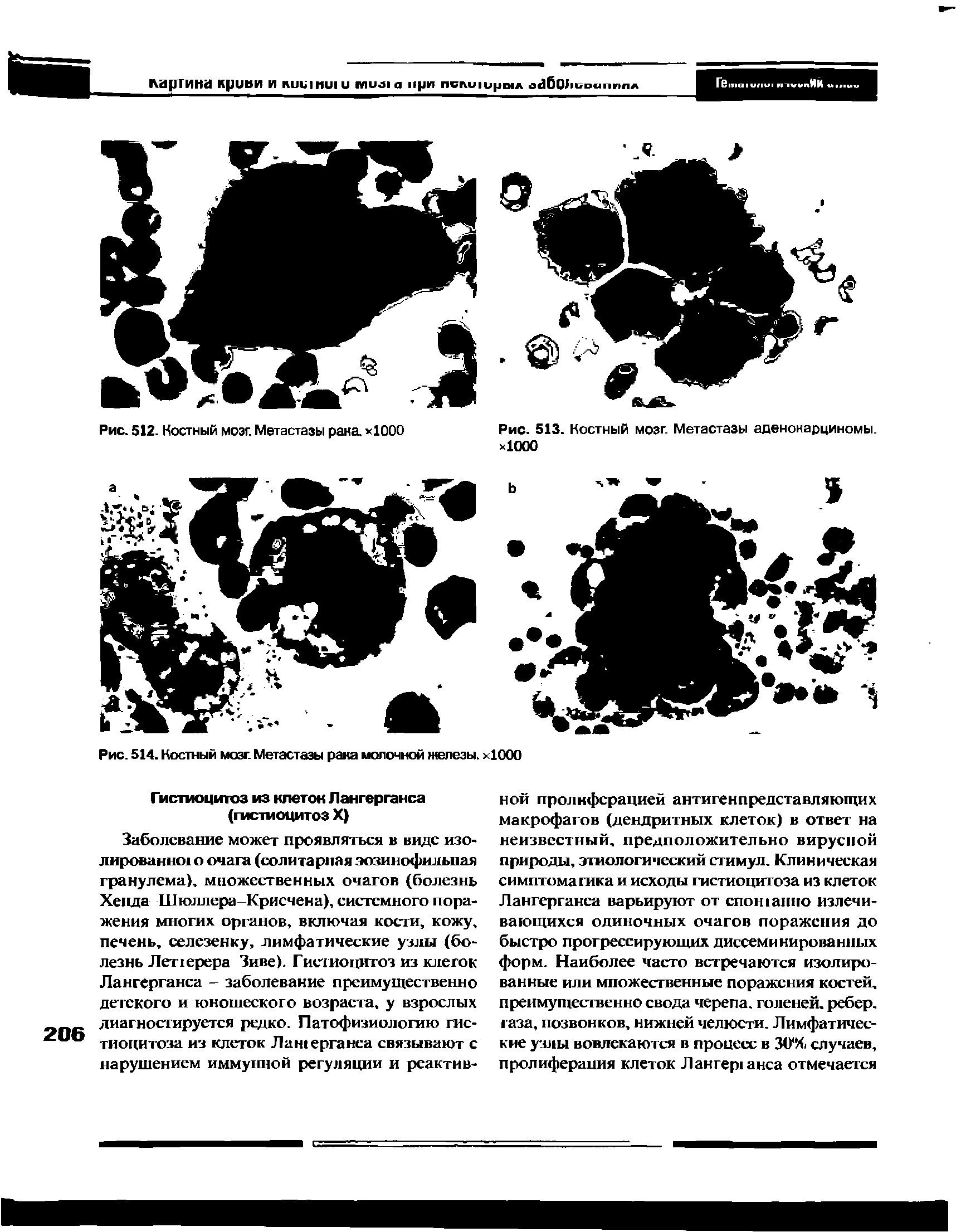 Рис. 514. Костный мозг. Метастазы рака молочной железы. х1000...