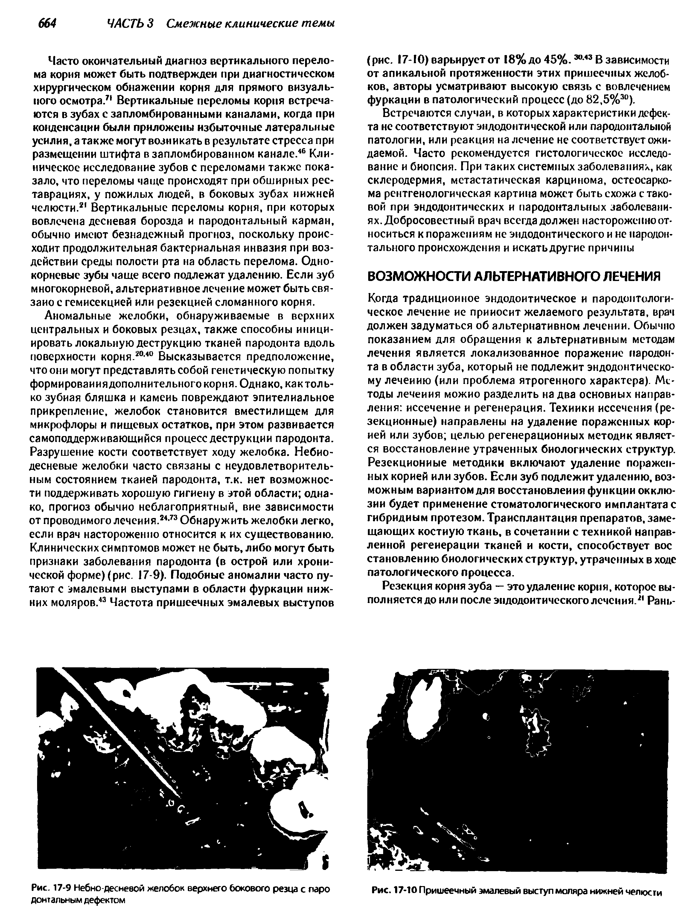 Рис. 17-9 Небно-десневой желобок верхнего бокового резца с паро донтальным дефектом...