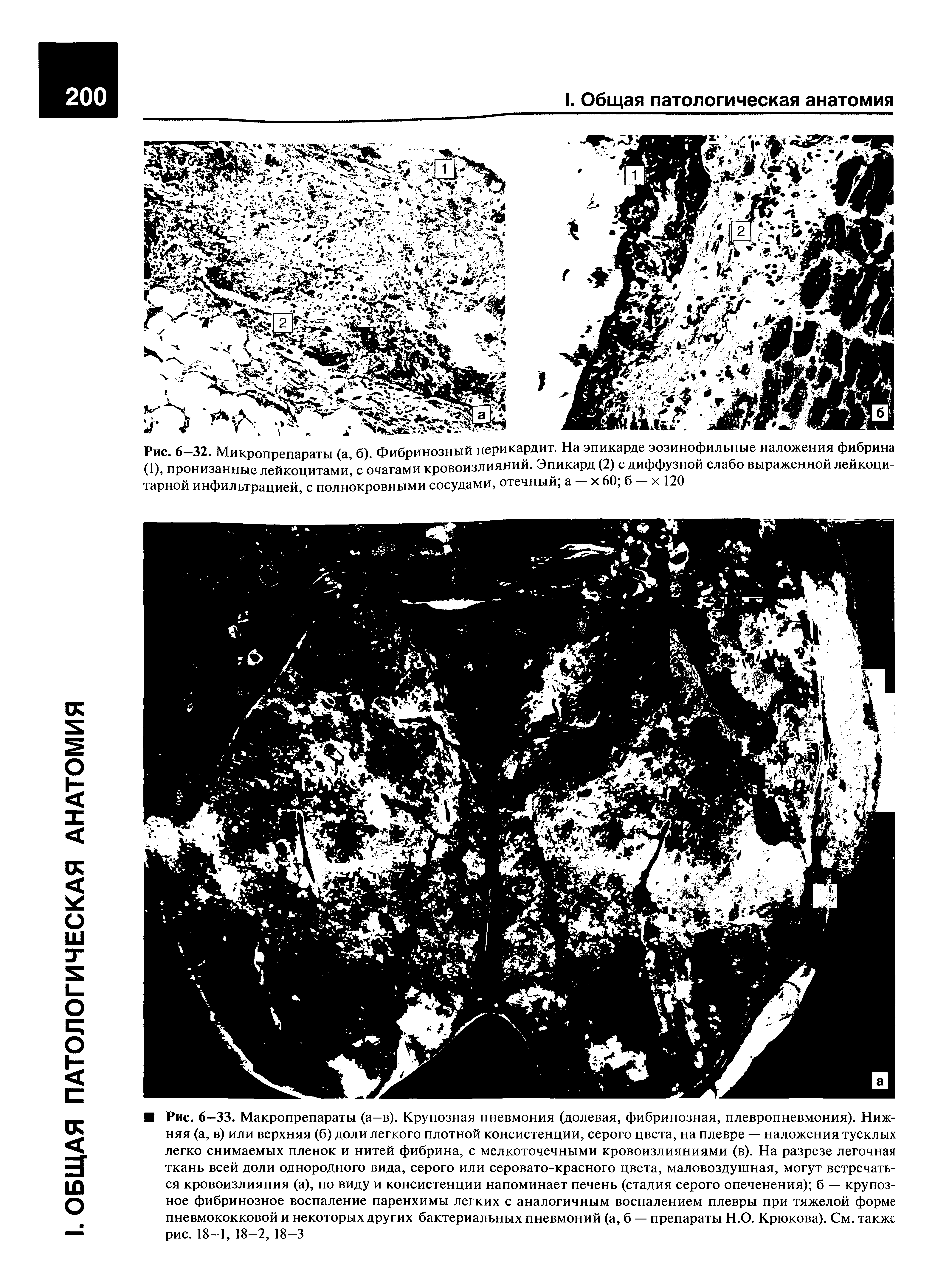 Рис. 6-32. Микропрепараты (а б) Фибринозный перикардит. На эпикарде эозинофильные наложения фибрина (1), пронизанные лейкоцитами , с очагами кровоизлияний. Эпикард (2) с диффузной слабо выраженной лейкоцитарной инфильтрацией, с полнокровными сосудами, отечный а — х 60 б — х 120...