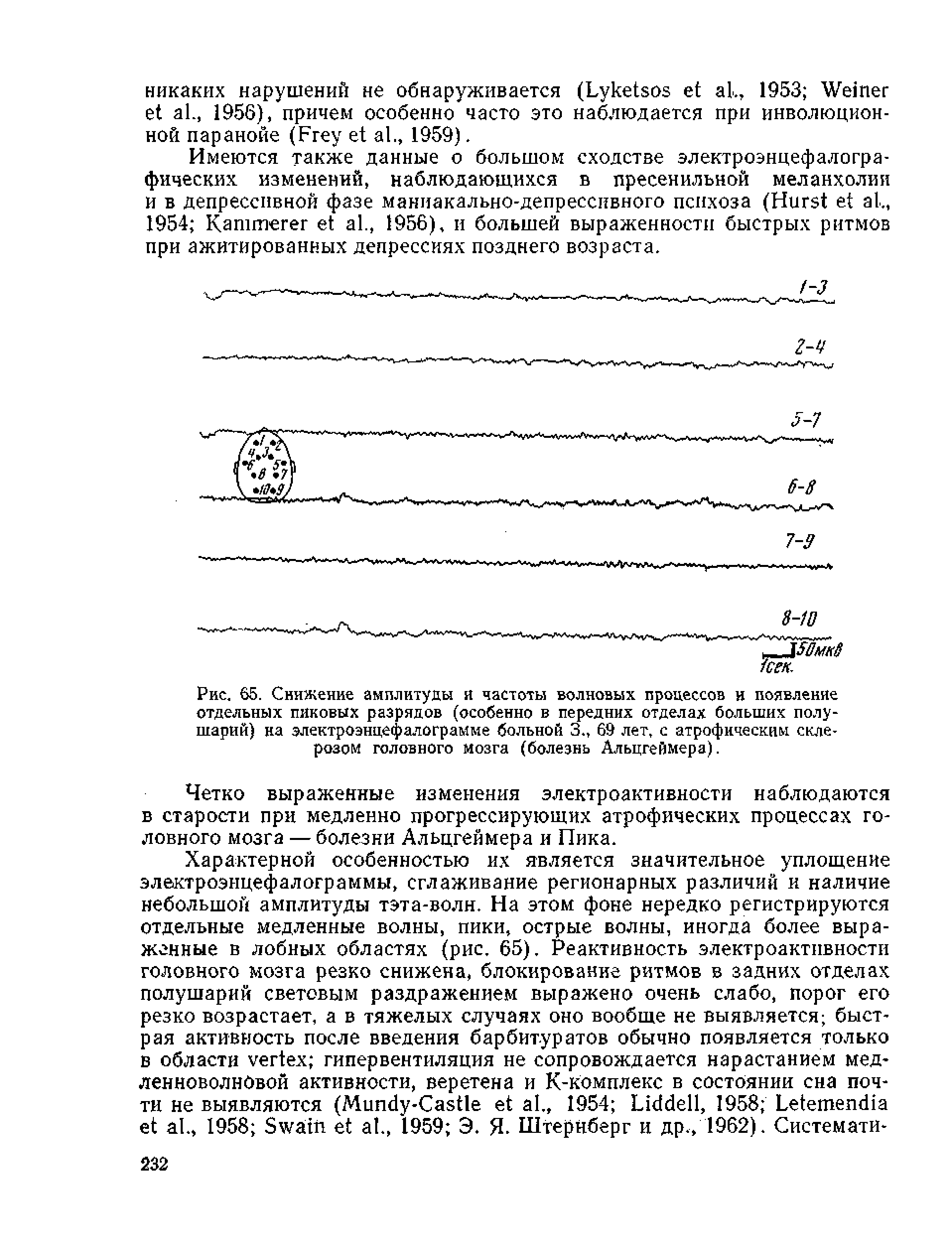 Рис. 65. Снижение амплитуды я частоты волновых процессов и появление отдельных пиковых разрядов (особенно в передних отделах больших полушарий) на электроэнцефалограмме больной 3., 69 лет, с атрофическим склерозом головного мозга (болезнь Альцгеймера).