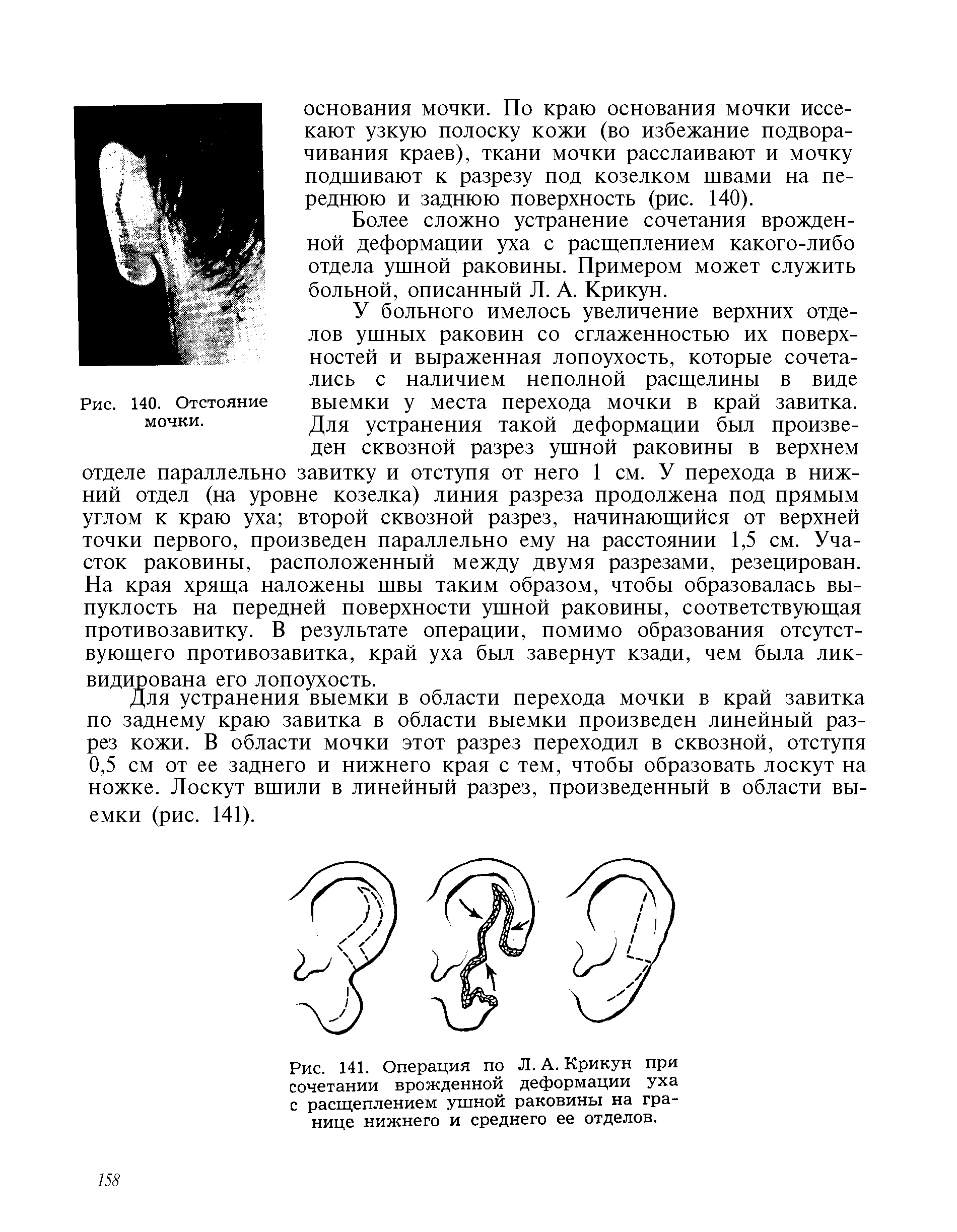Рис. 141. Операция по Л. А. Крикун при сочетании врожденной деформации уха с расщеплением ушной раковины на границе нижнего и среднего ее отделов.