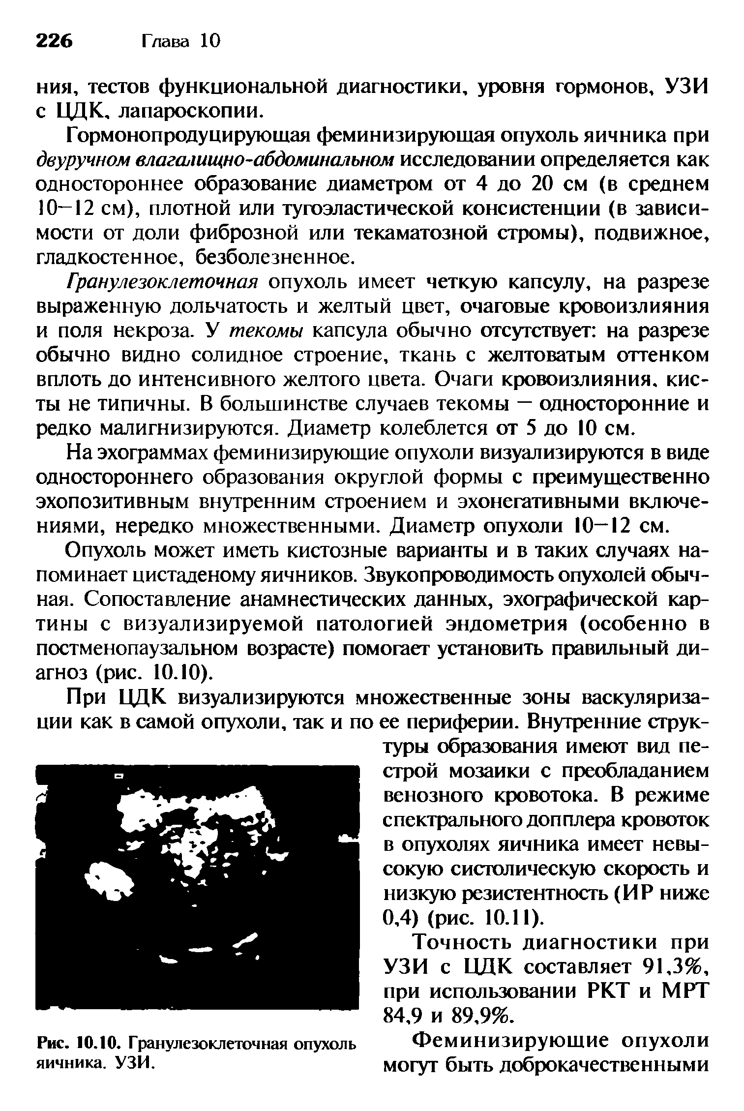 Рис. 10.10. Гранулезоклеточная опухоль Феминизирующие опухоли яичника, узи. могут быть доброкачественными...