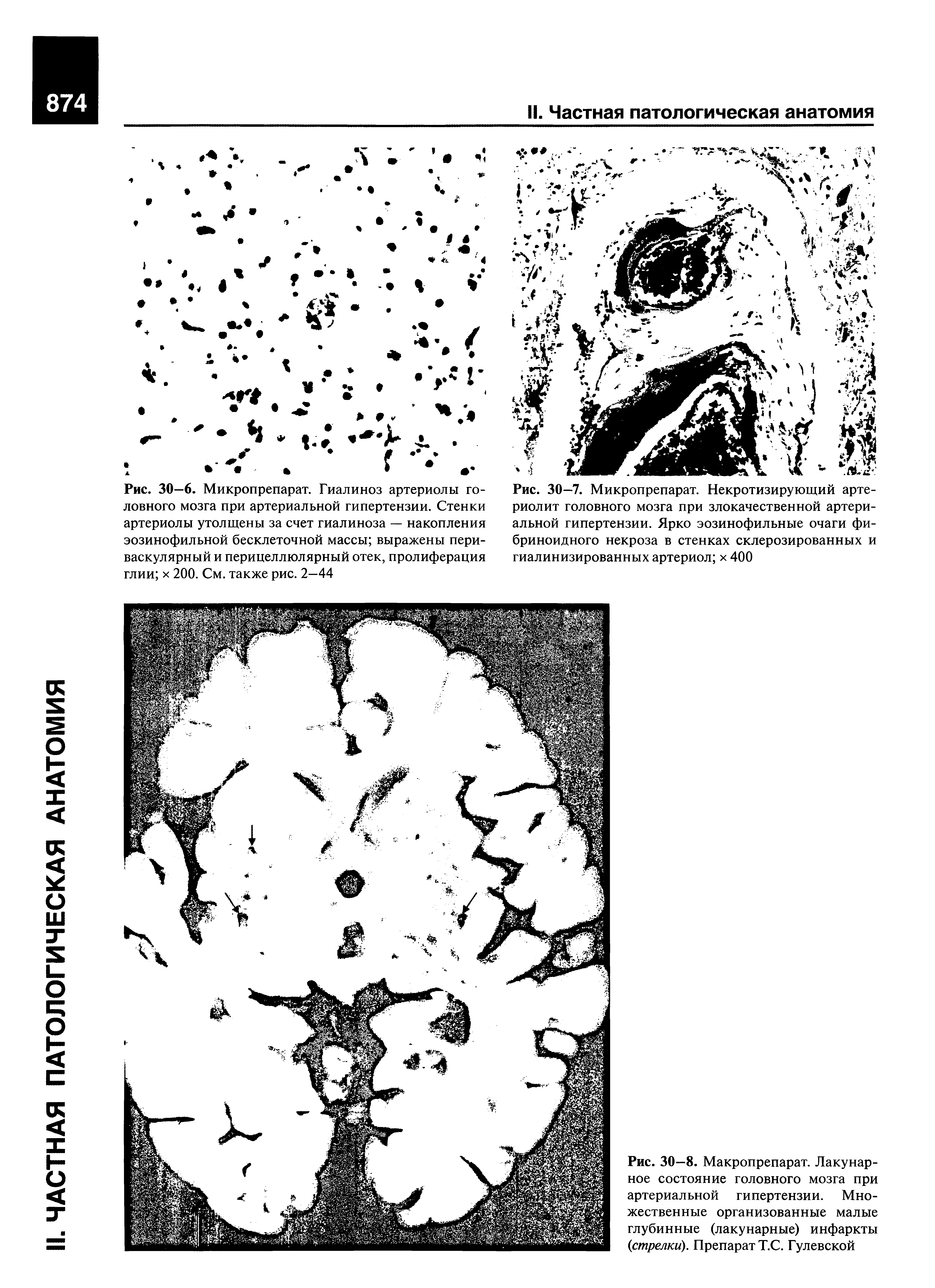 Рис. 30—8. Макропрепарат. Лакунарное состояние головного мозга при артериальной гипертензии. Множественные организованные малые глубинные (лакунарные) инфаркты стрелки). Препарат Т.С. Гулевской...