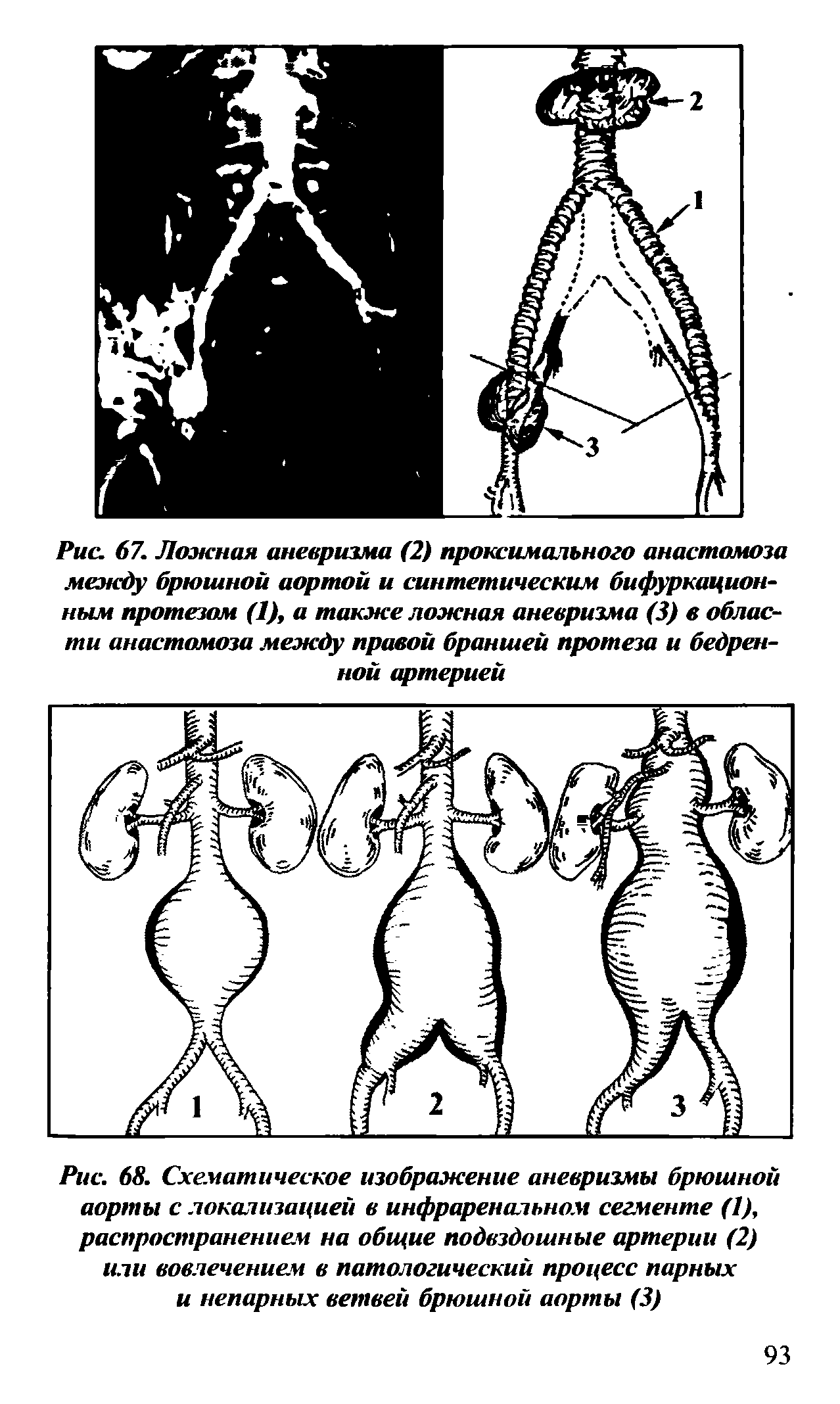 Рис. 68. Схематическое изображение аневризмы брюшной аорты с локализацией в инфраренальном сегменте (1), распространением на общие подвздошные артерии (2) или вовлечением в патологический процесс парных и непарных ветвей брюшной аорты (3)...