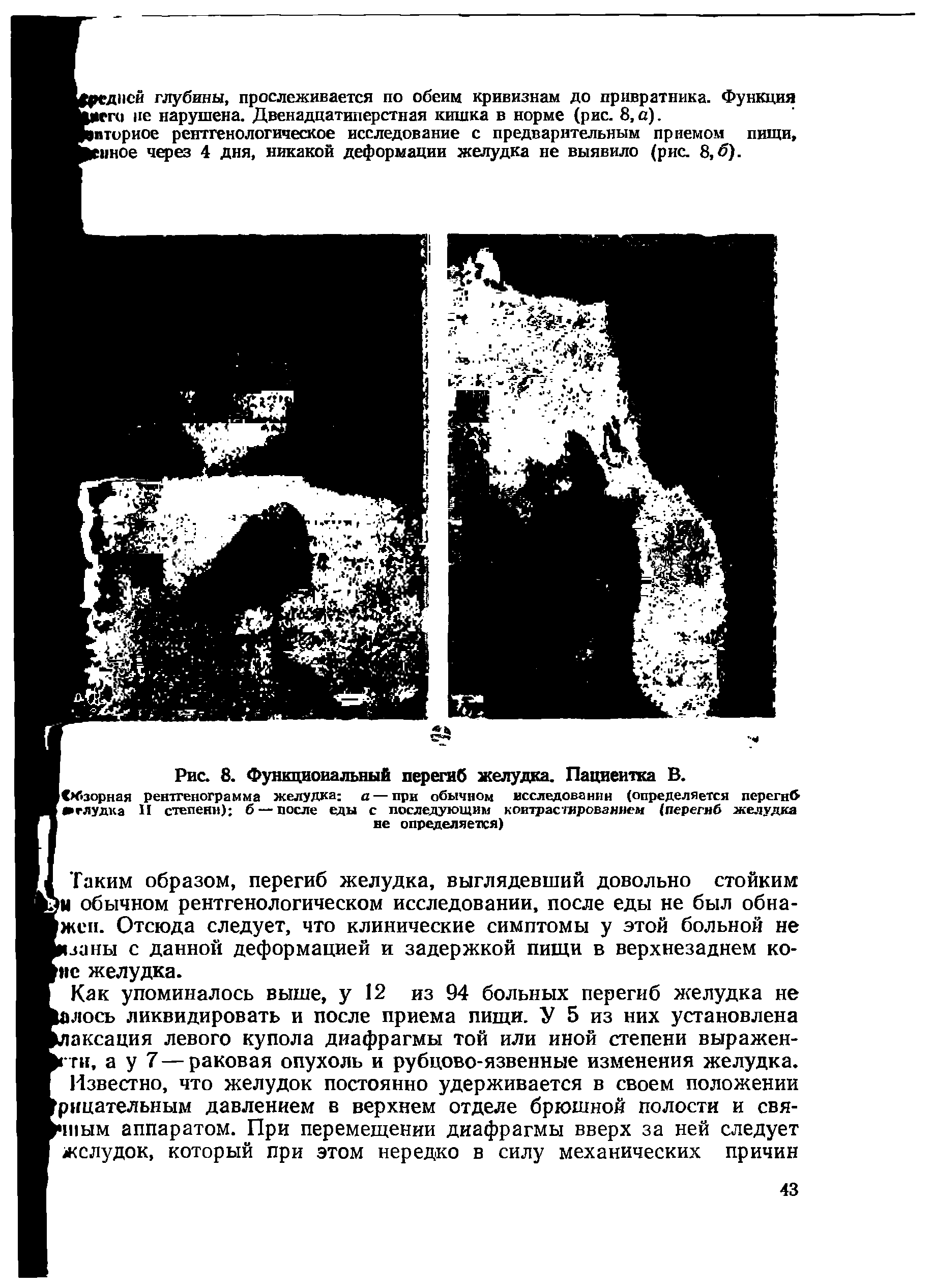 Рис. 8. Функциональный перегиб желудка. Пациентка В. рентгенограмма желудка а — при обычном исследовании (определяется перегиб И степени) б —после еды с последующим контрастированием (перегиб желудка не определяется)...