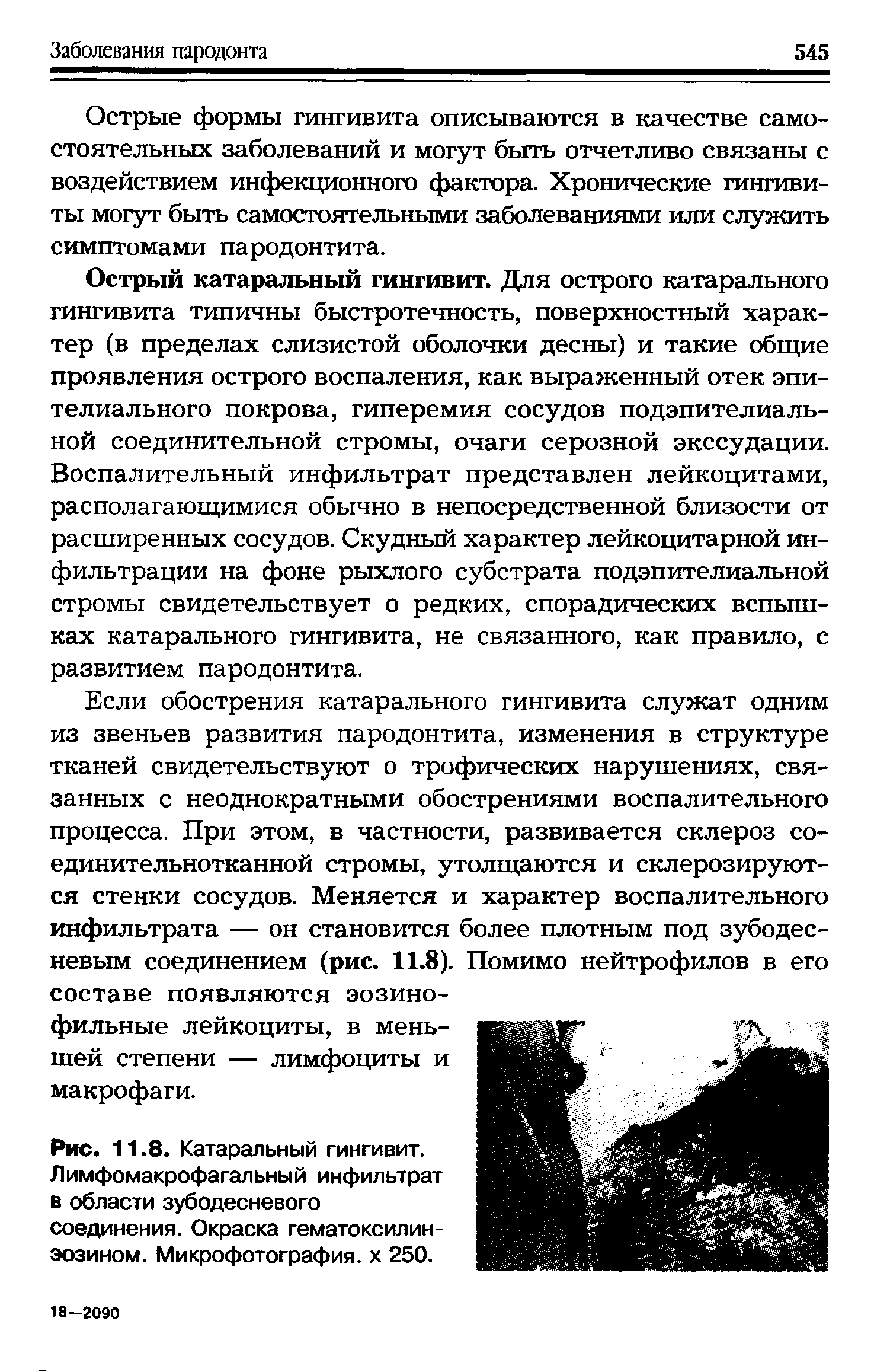 Рис. 11.8. Катаральный гингивит. Лимфомакрофагальный инфильтрат в области зубодесневого соединения. Окраска гематоксилин-эозином. Микрофотография, х 250.