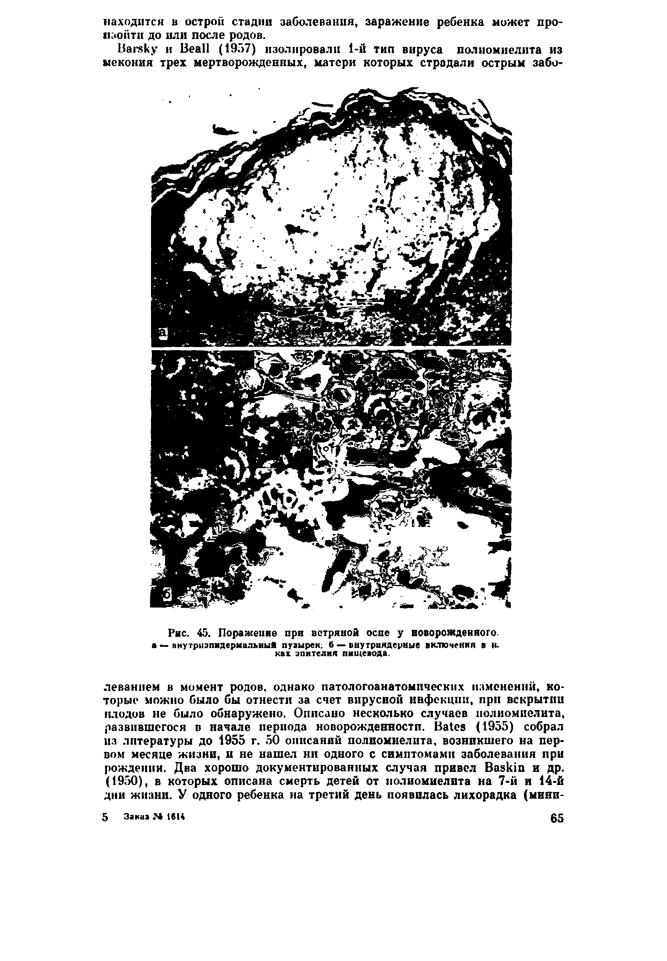 Рис. 45. Поражение при ветряной оспе у новорожденного а — внутриэпидермальный пузырек, б — внутриядерные включения в к. ках эпителия пищевода.