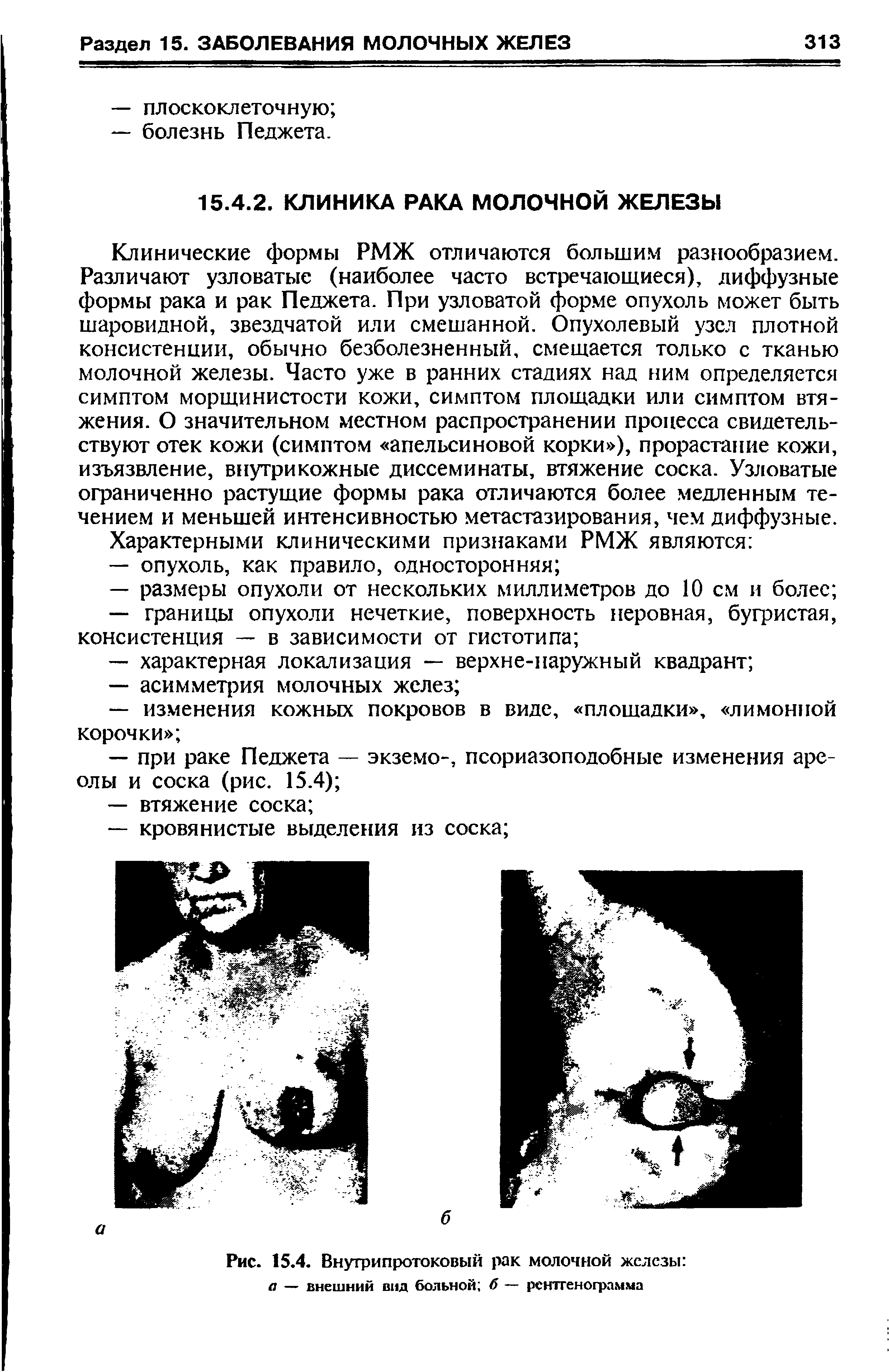 Рис. 15.4. Внутрипротоковый рак молочной железы а — внешний вид больной б — рентгенограмма...