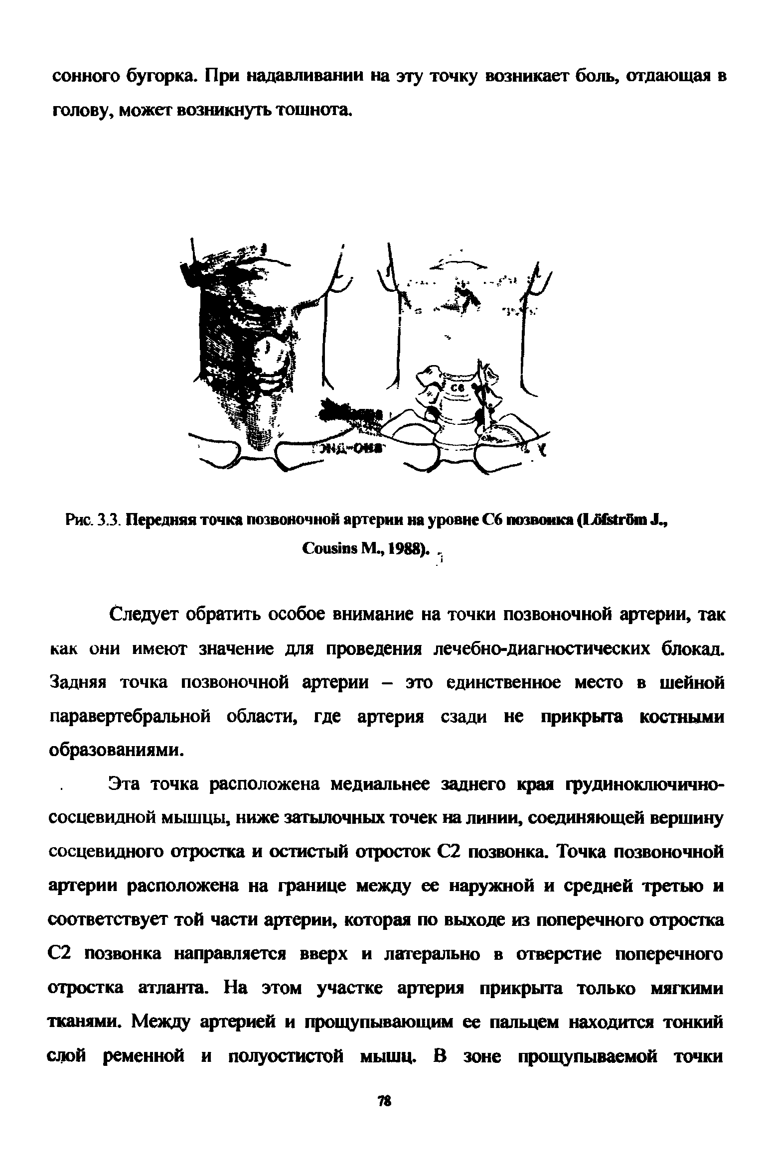 Рис. 3.3. Передняя точка позвоночной артерии на уровне С6 позвонка (L6 6 J., C М., 1988).. ...