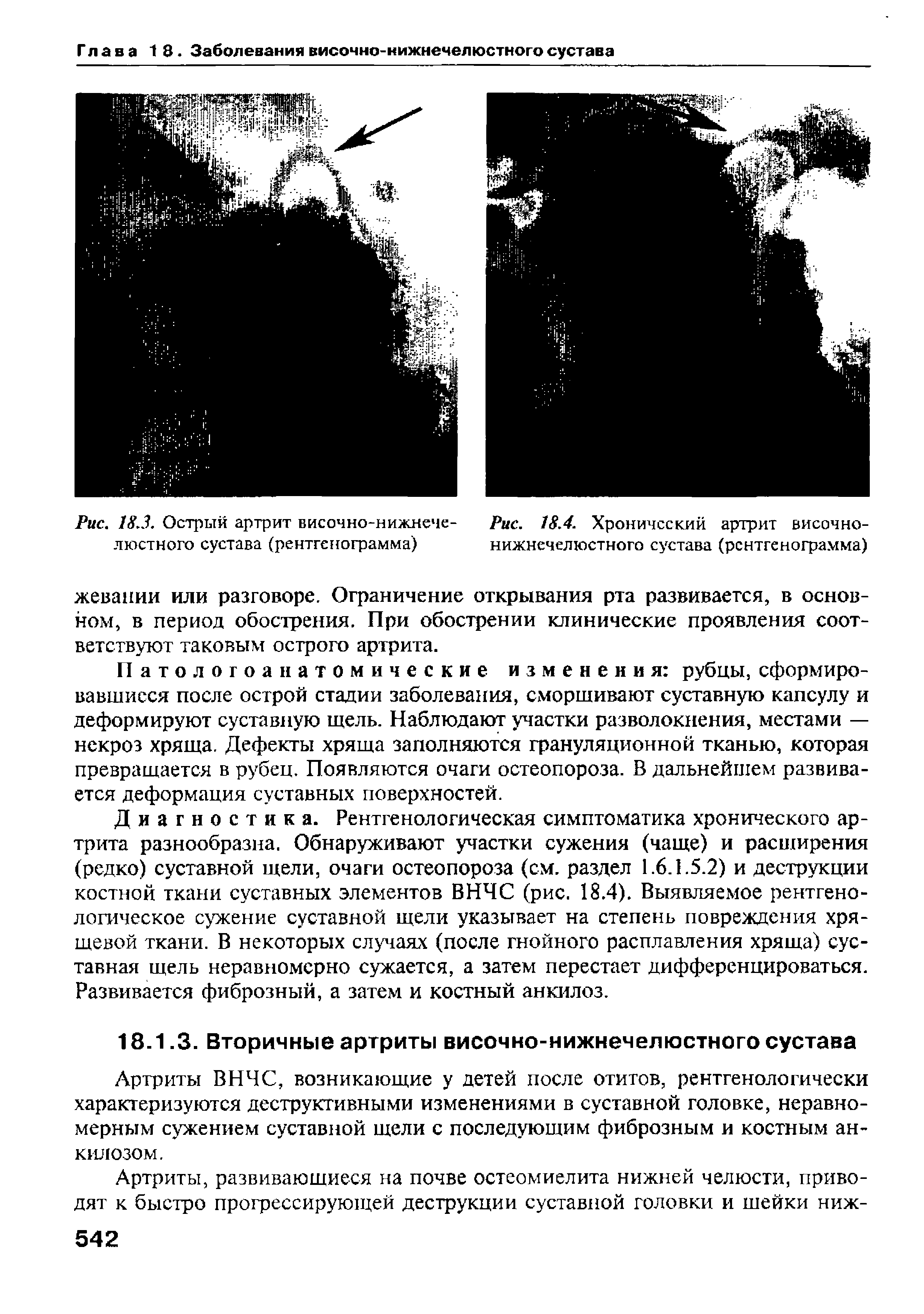 Рис. 18.4. Хронический артрит височно-нижнечелюстного сустава (рентгенограмма)...