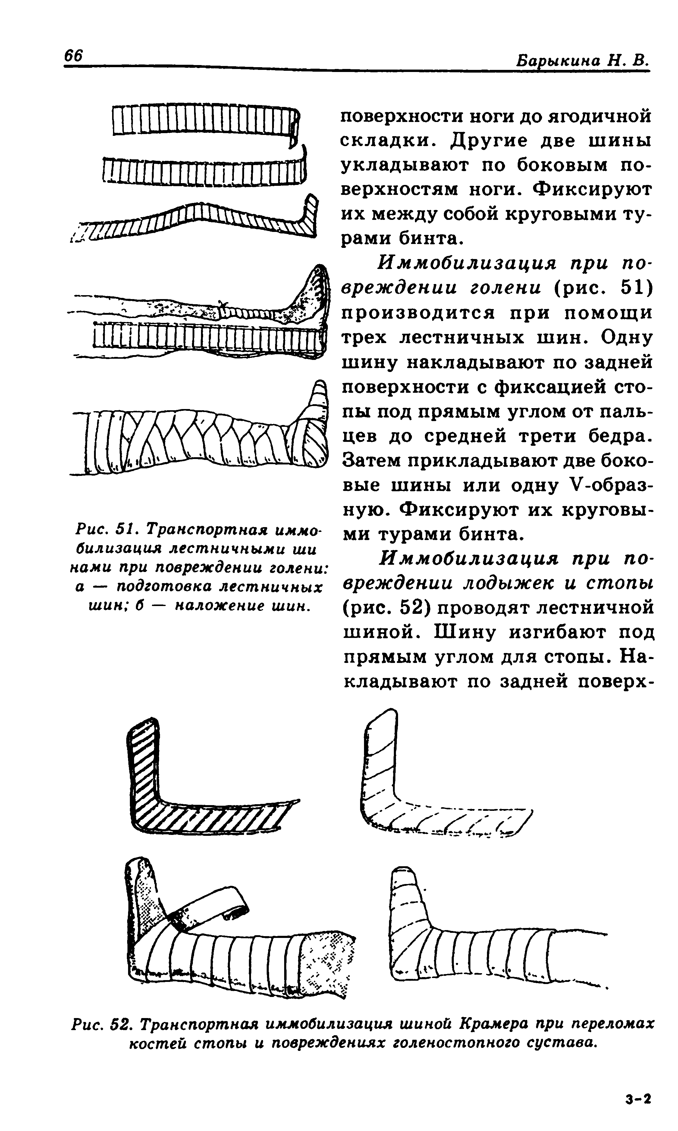 Рис. 52. Транспортная иммобилизация шиной Крамера при переломах костей стопы и повреждениях голеностопного сустава.