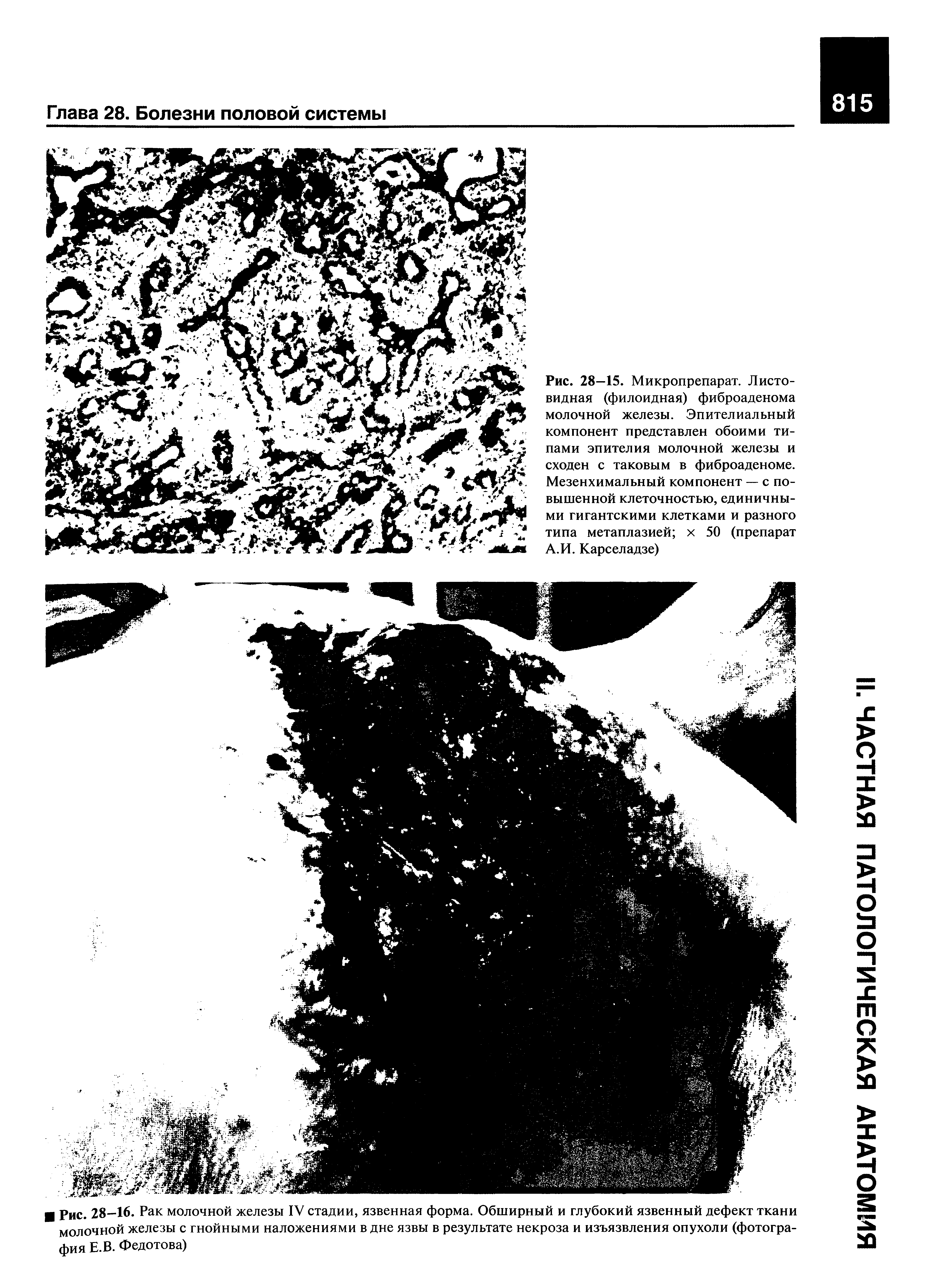 Рис. 28—16. Рак молочной железы IV стадии, язвенная форма. Обширный и глубокий язвенный дефект ткани молочной железы с гнойными наложениями в дне язвы в результате некроза и изъязвления опухоли (фотография Е.В. Федотова)...