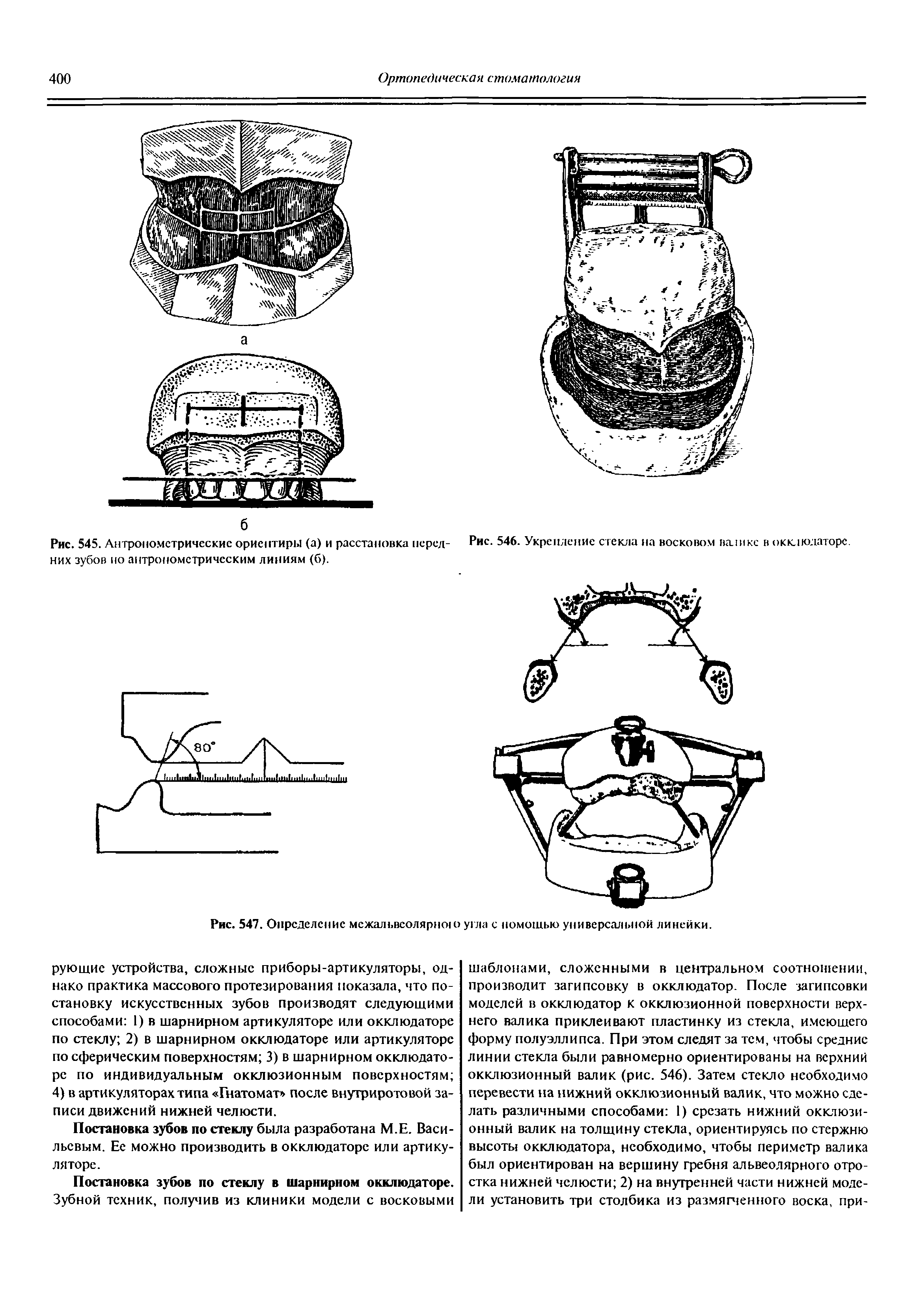 Рис. 545. Антропометрические ориентиры (а) и расстановка перед- Рис. 546. Укрепление стекла на восковом валике в окклюдаторе. них зубов по антропометрическим линиям (б).