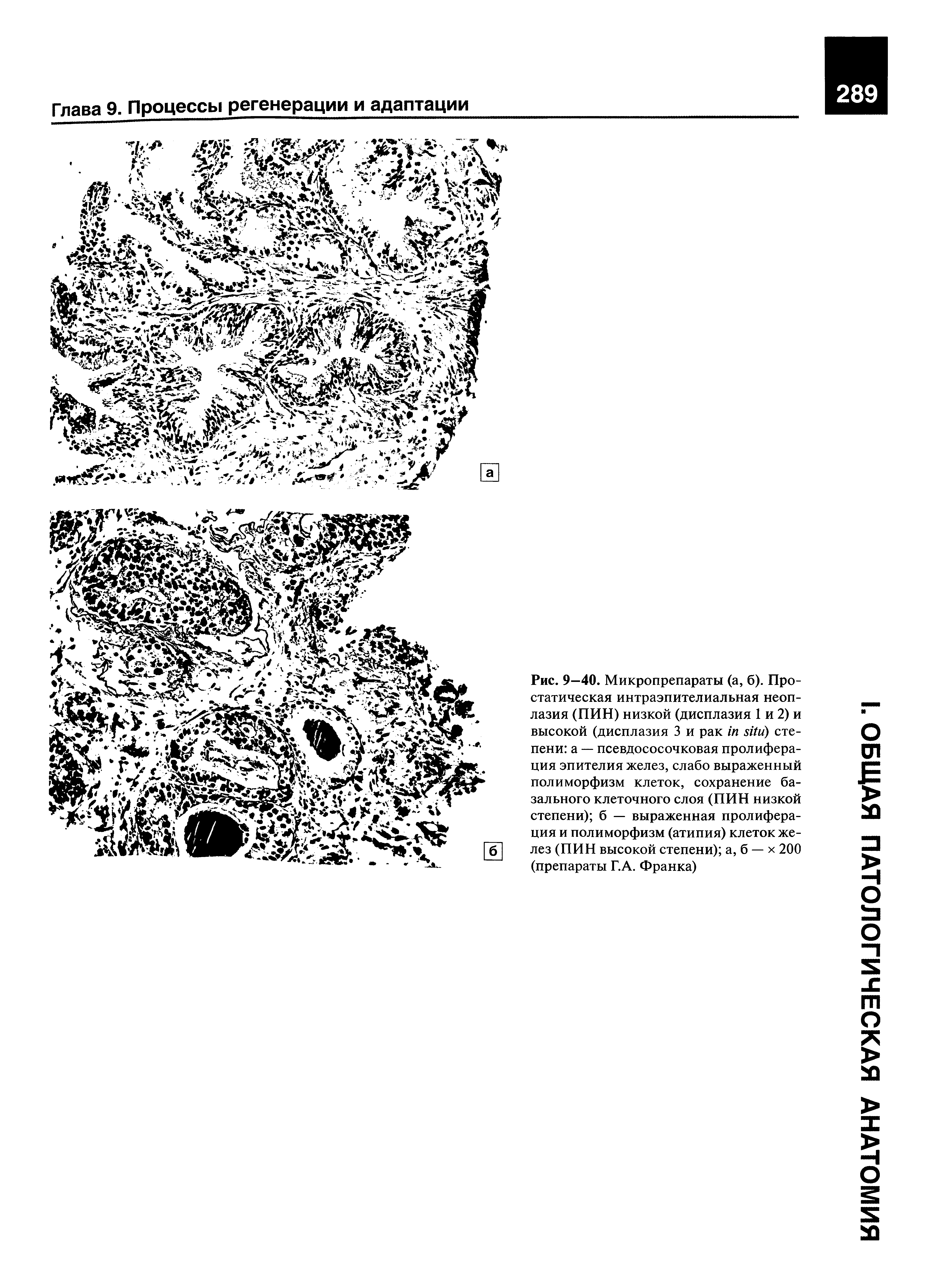 Рис. 9—40. Микропрепараты (а, б). Простатическая интраэпителиальная неоплазия (ПИН) низкой (дисплазия 1 и 2) и высокой (дисплазия 3 и рак ) степени а — псевдососочковая пролиферация эпителия желез, слабо выраженный полиморфизм клеток, сохранение базального клеточного слоя (ПИН низкой степени) б — выраженная пролиферация и полиморфизм (атипия) клеток желез (ПИН высокой степени) а, б — х 200 (препараты Г.А. Франка)...