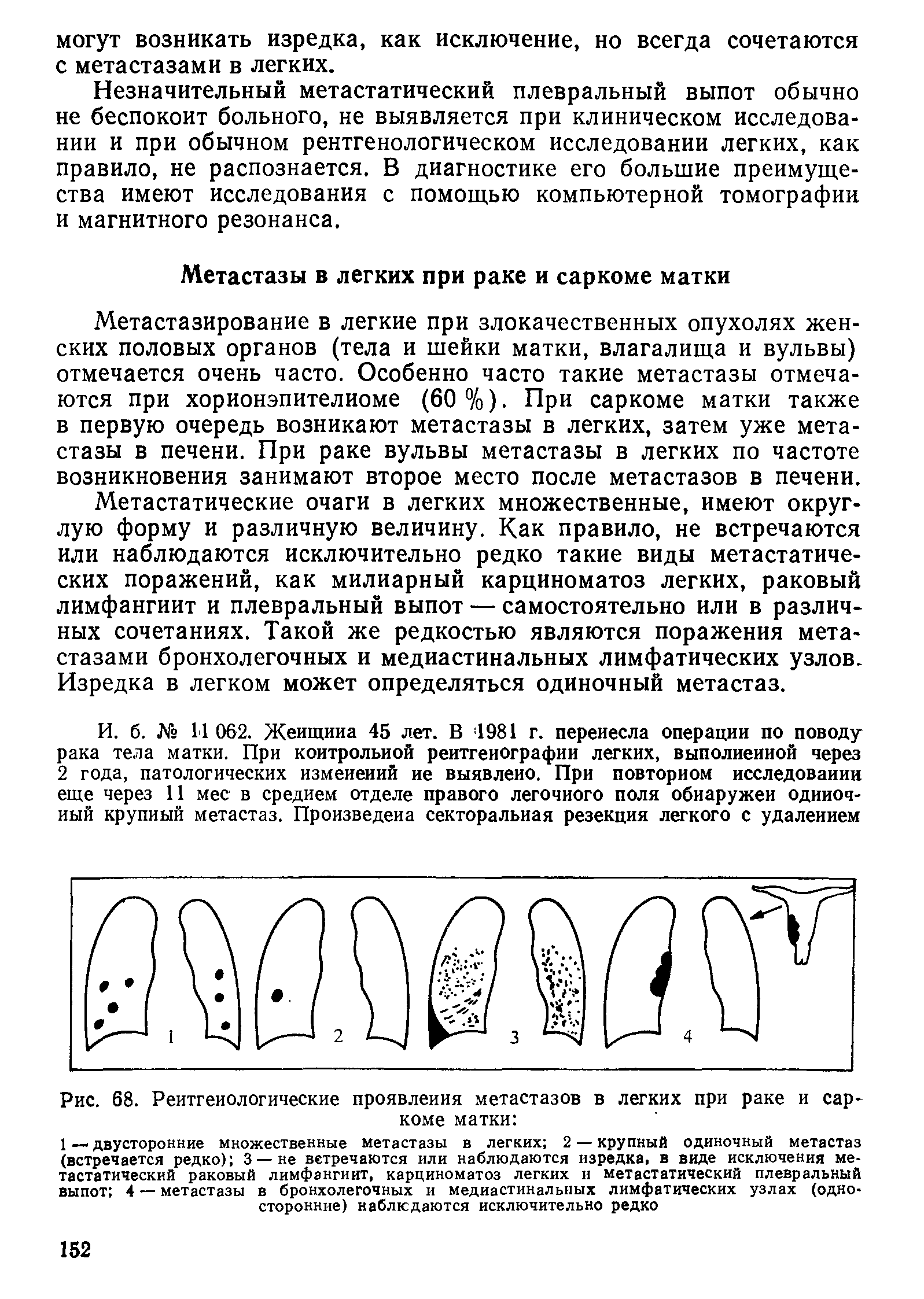 Рис. 68. Реитгеиологические проявления метастазов в легких при раке и саркоме матки ...