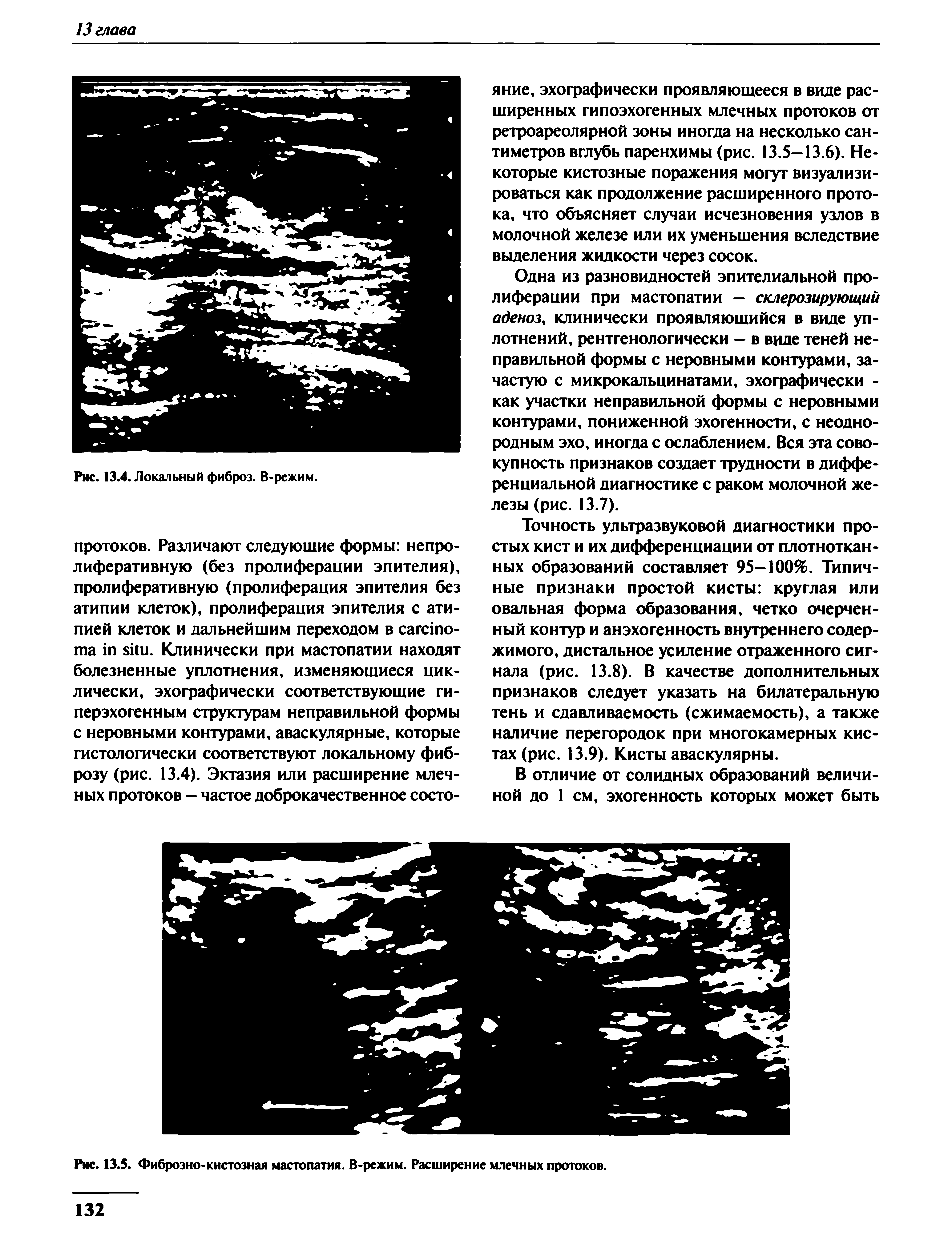 Рис. 13.5. Фиброзно-кистозная мастопатия. В-режим. Расширение млечных протоков.