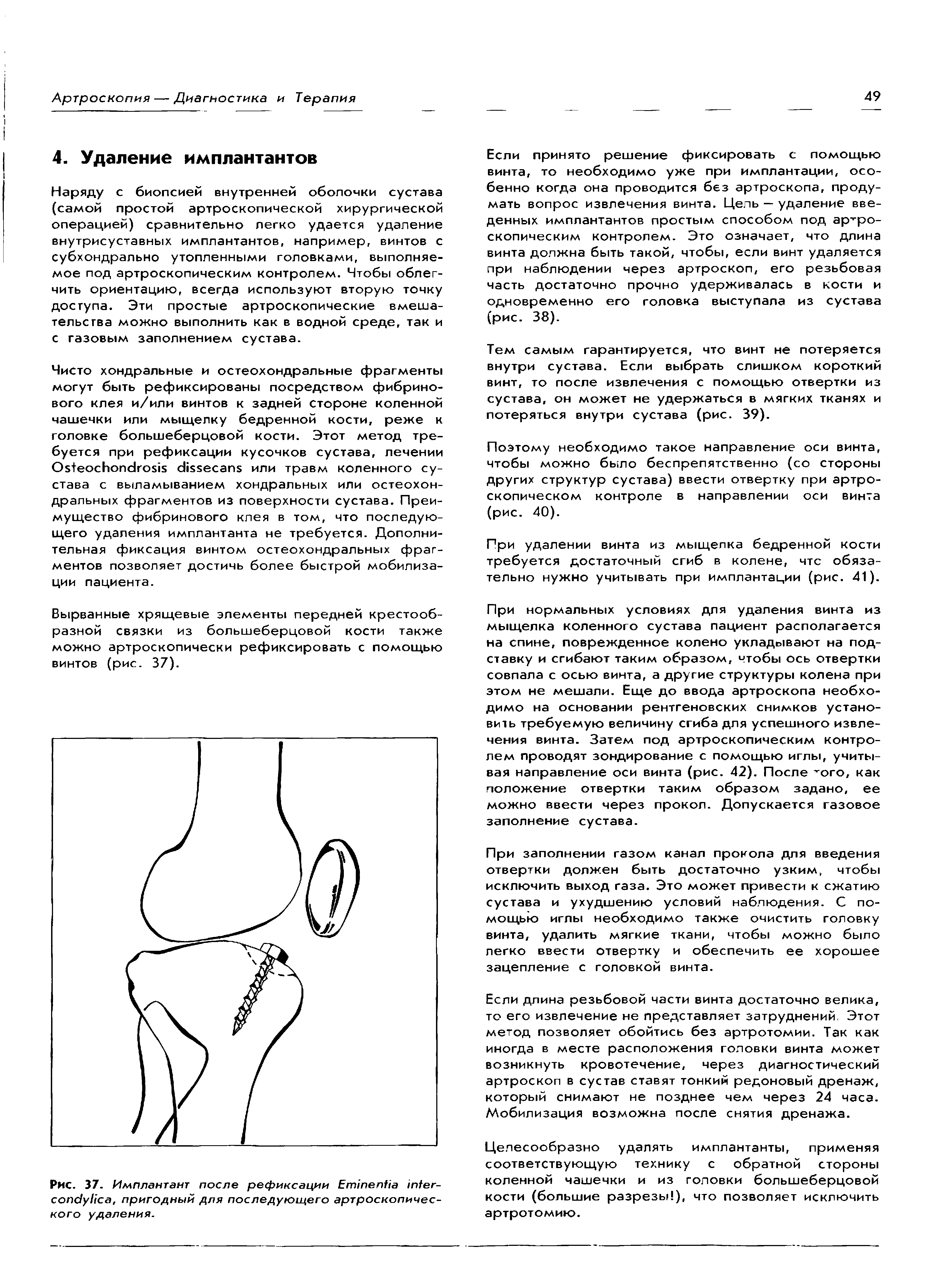 Рис. 37. Имплантант после рефиксации Егтнпеп/1а т/ег-сопс уНса, пригодный для последующего артроскопического удаления.