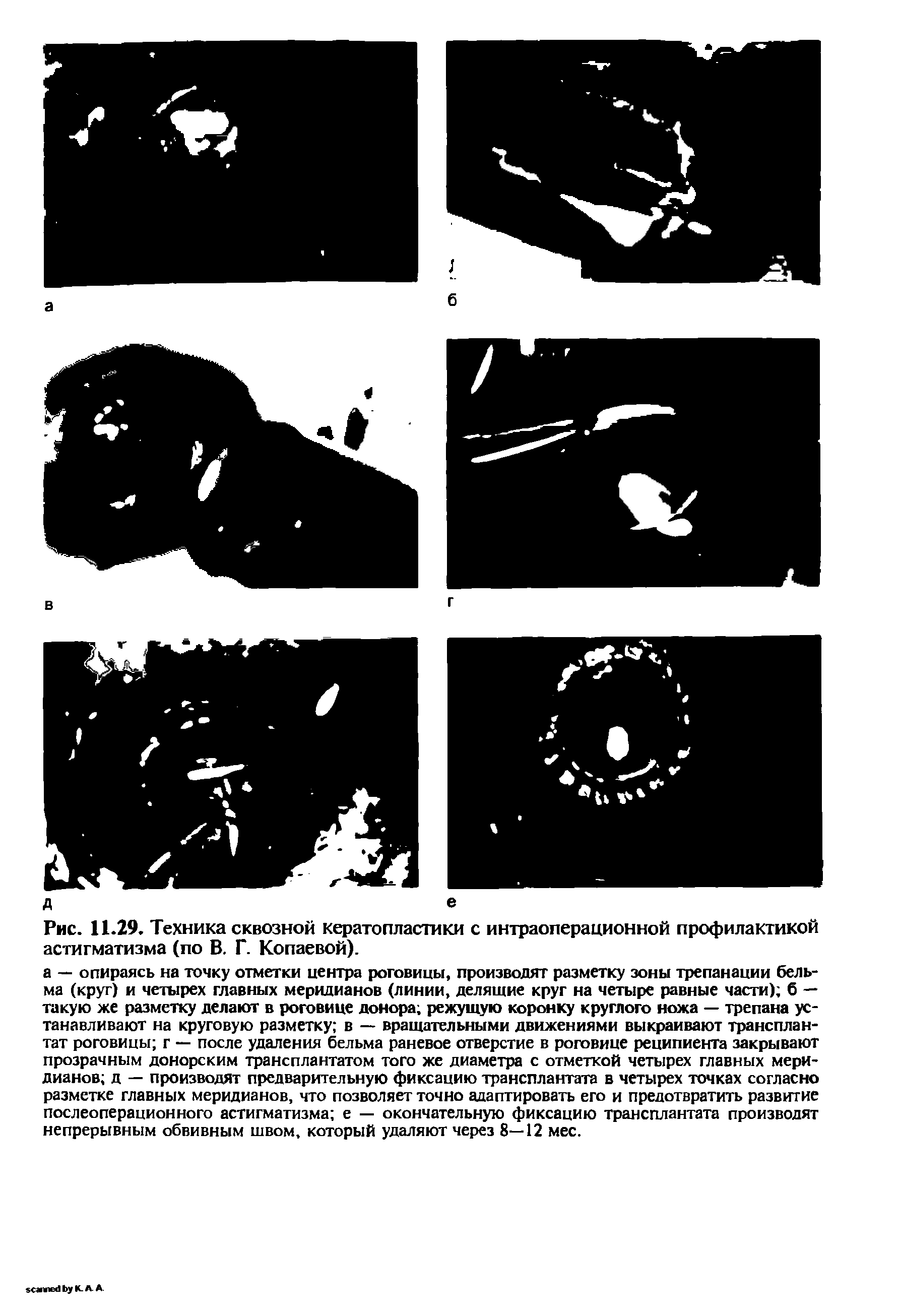 Рис. 11.29. Техника сквозной кератопластики с интраоперационной профилактикой астигматизма (по В. Г. Копаевой).
