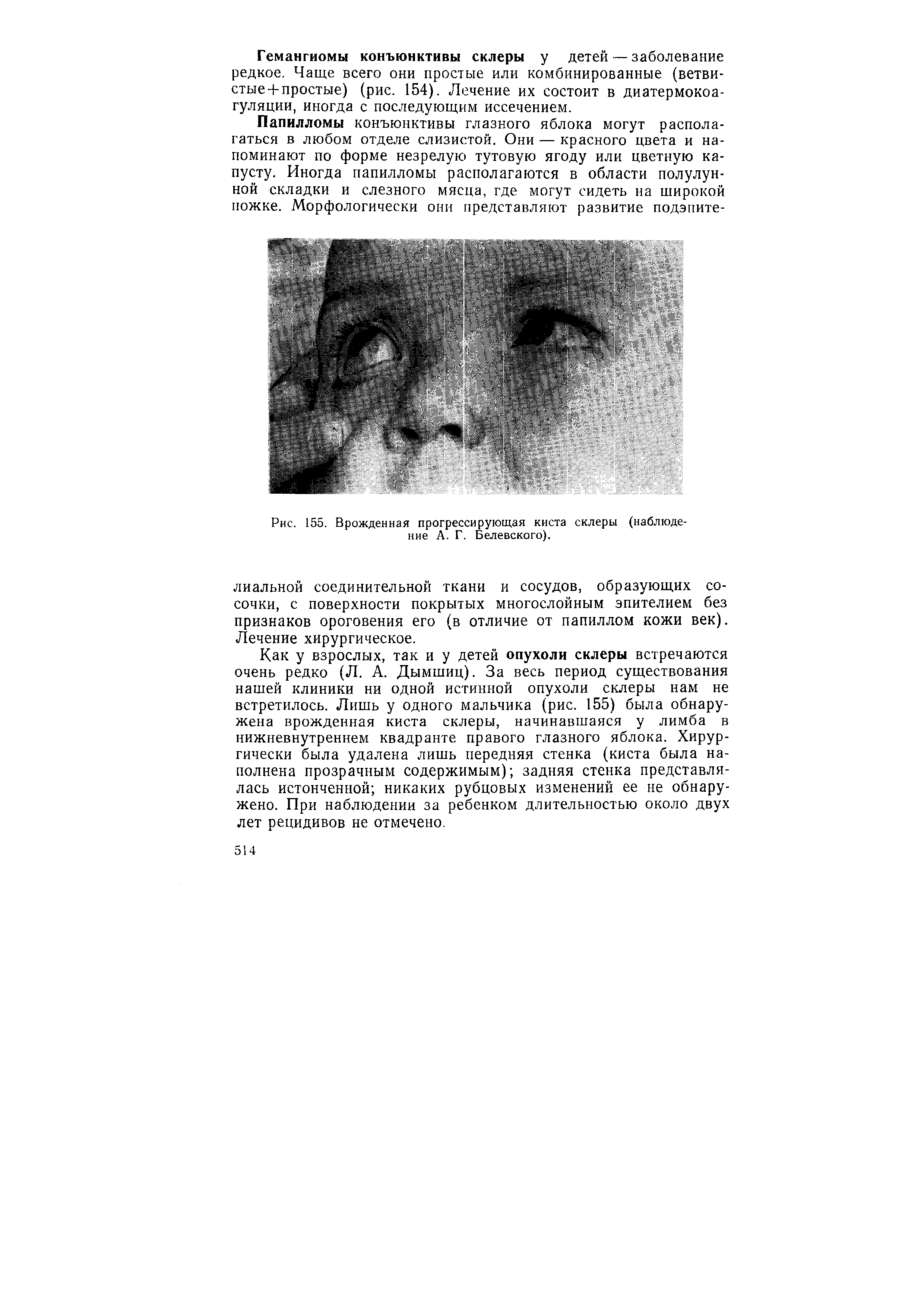 Рис. 155. Врожденная прогрессирующая киста склеры (наблюдение А. Г. Белевского).