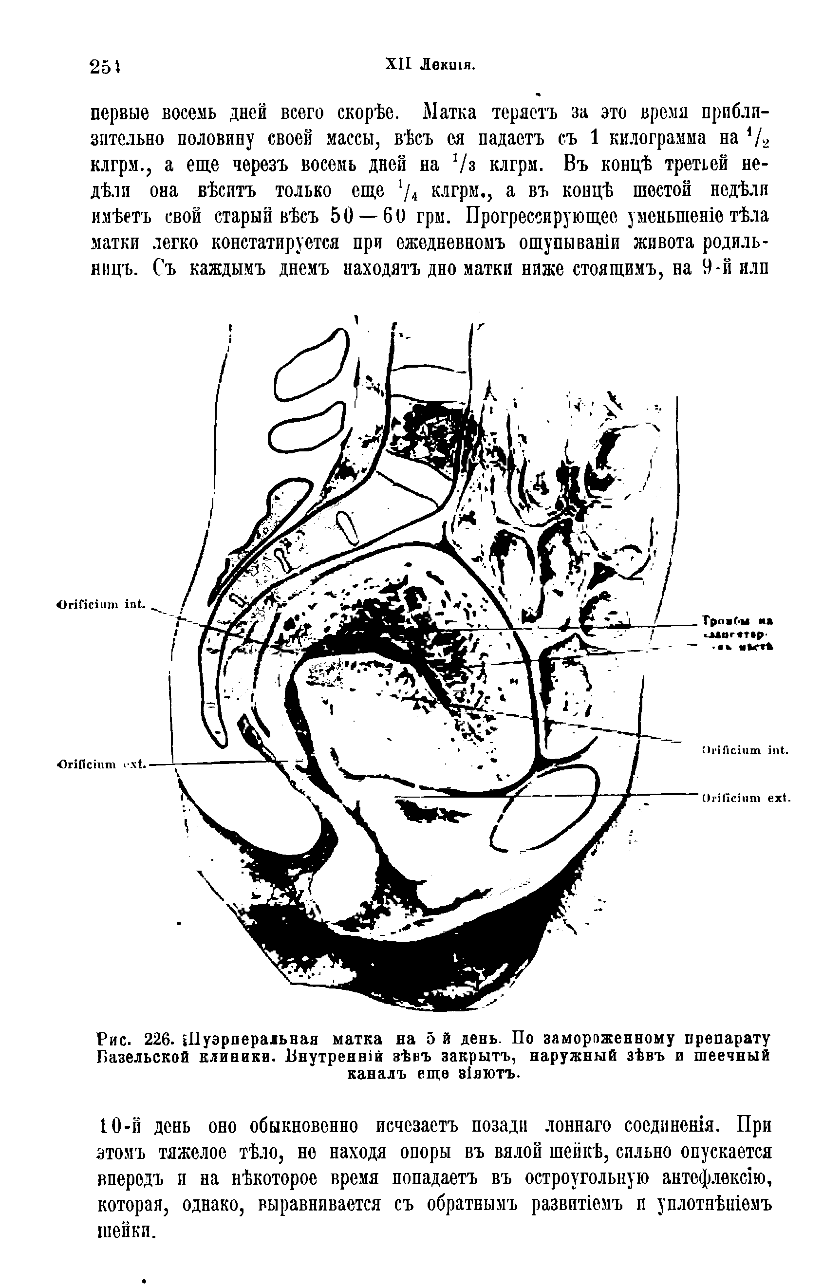 Рис. 226. Пуэрперальная матка на 5 й день. По замороженному препарату Базельской клиники. Внутренней зЪбъ закрыть, наружный зЪвъ и шеечный каналъ еще з1яютъ.
