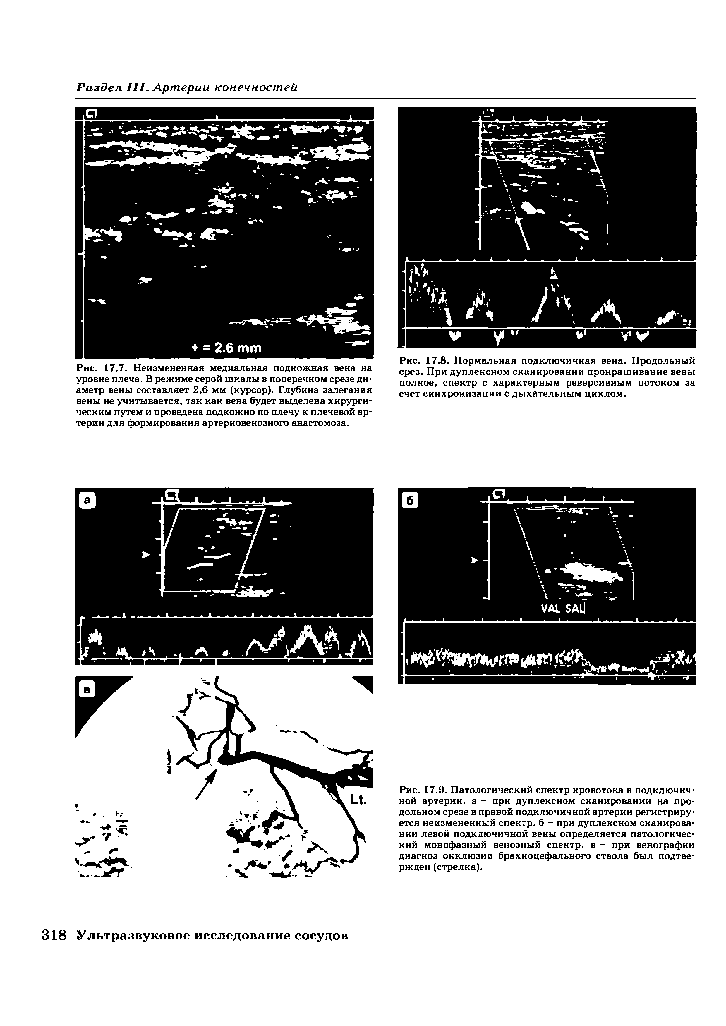 Рис. 17.9. Патологический спектр кровотока в подключичной артерии, а - при дуплексном сканировании на продольном срезе в правой подключичной артерии регистрируется неизмененный спектр, б - при дуплексном сканировании левой подключичной вены определяется патологический монофазный венозный спектр, в - при венографии диагноз окклюзии брахиоцефального ствола был подтвержден (стрелка).