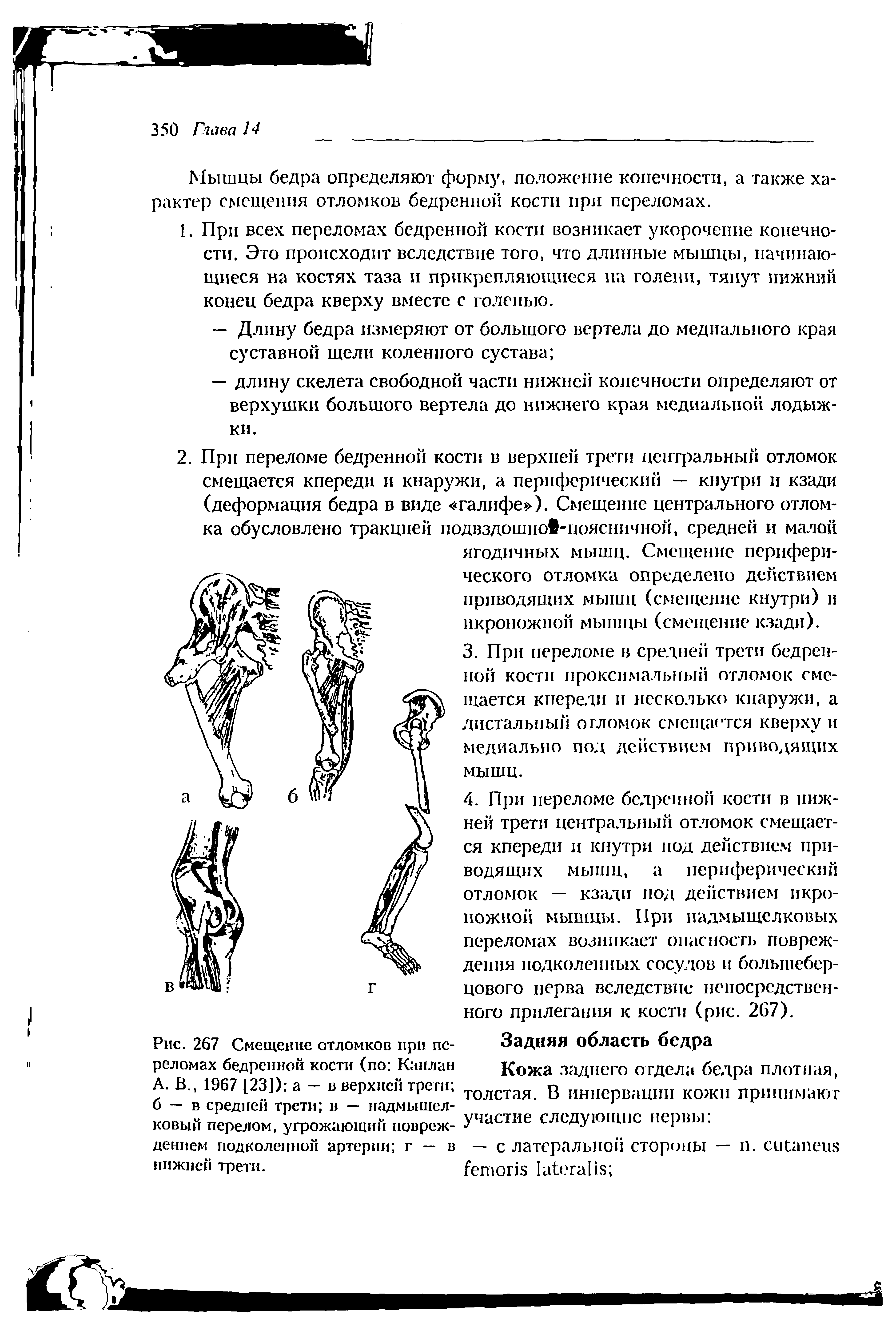 Рис. 267 Смещение отломков при переломах бедренной кости (по Каплан А. В., 1967 [23]) а — в верхней трети б — в средней трети в — надмыщелковый перелом, угрожающий повреждением подколенной артерии г — в нижней трети.