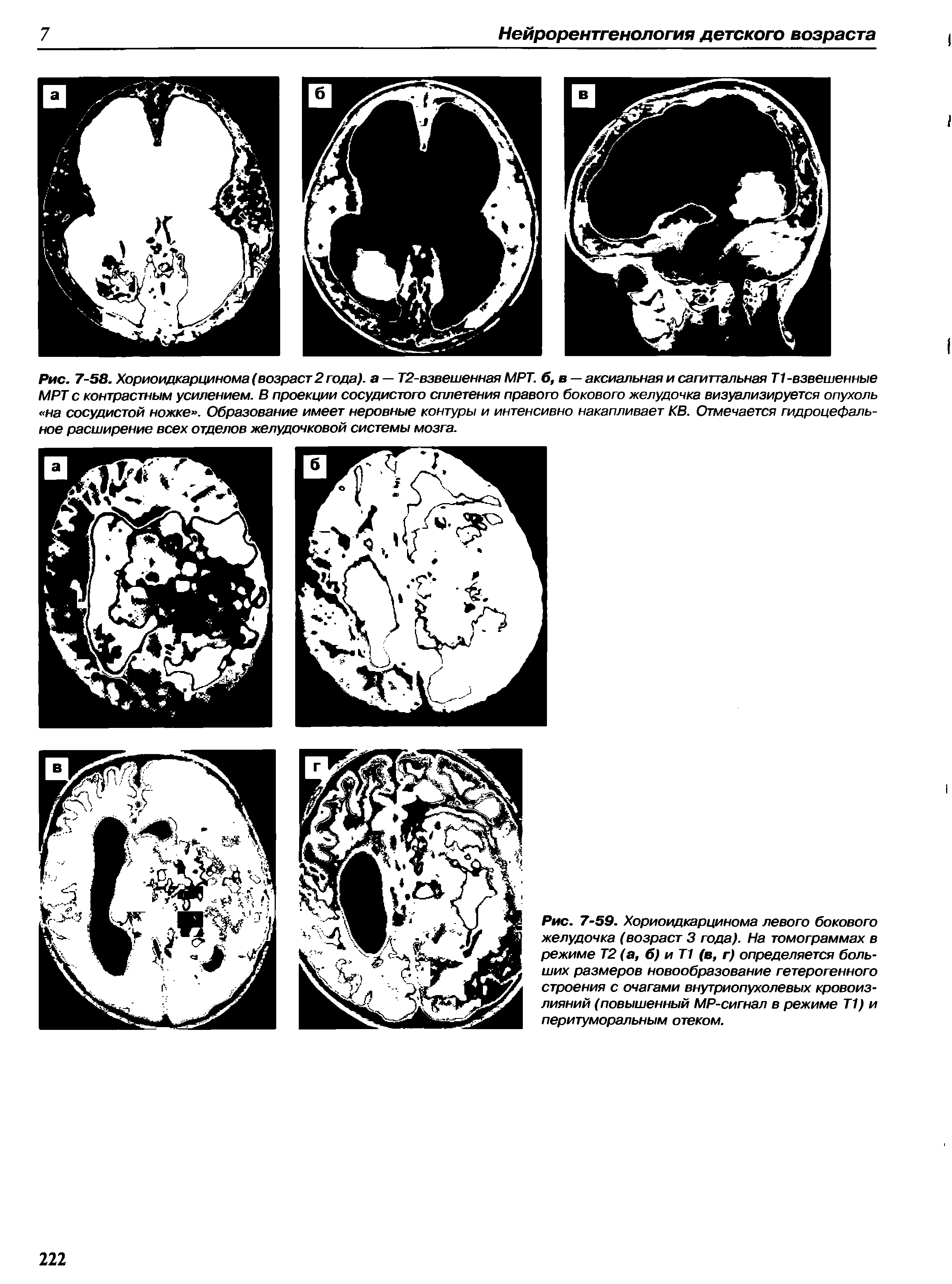 Рис. 7-59. Хориоидкарцинома левого бокового желудочка (возраст 3 года). На томограммах в режиме Т2 (а, б) и Т1 (в, г) определяется больших размеров новообразование гетерогенного строения с очагами внутриопухолевых кровоизлияний (повышенный МР-сигнал в режиме Т1) и перитуморальным отеком.