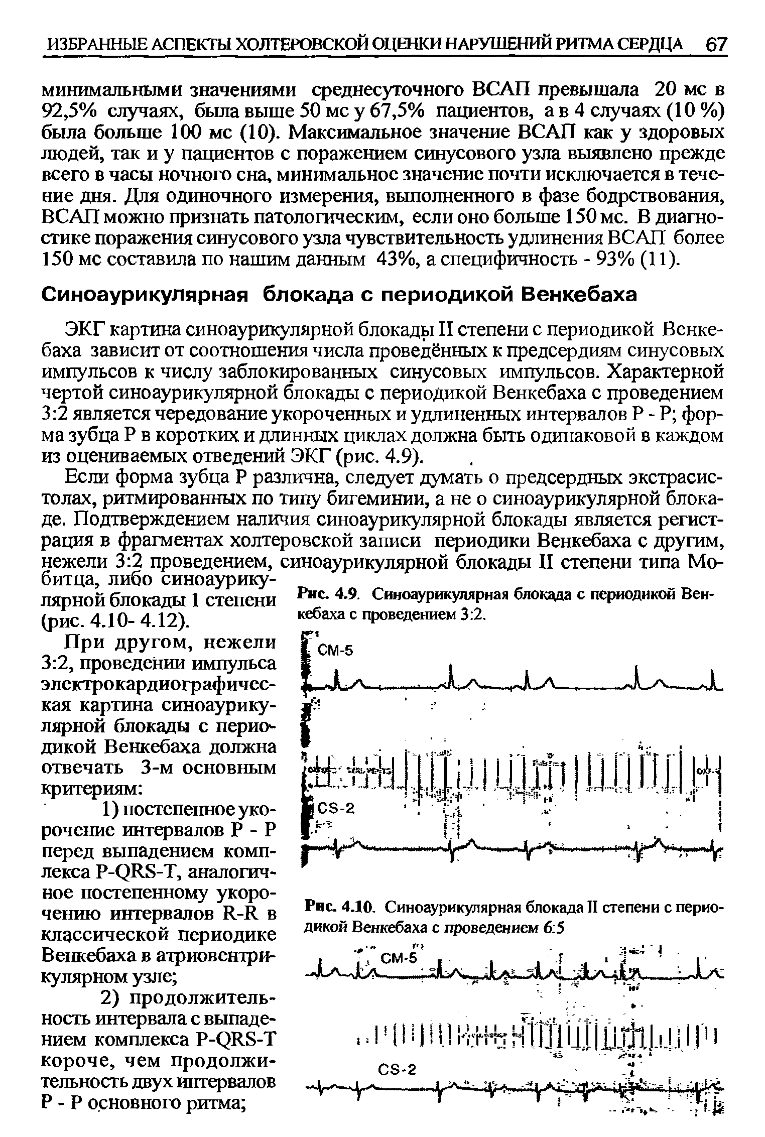 Рис. 4.10. Синоаурикулярная блокада II степени с периодикой Венкебаха с проведением 6 5...