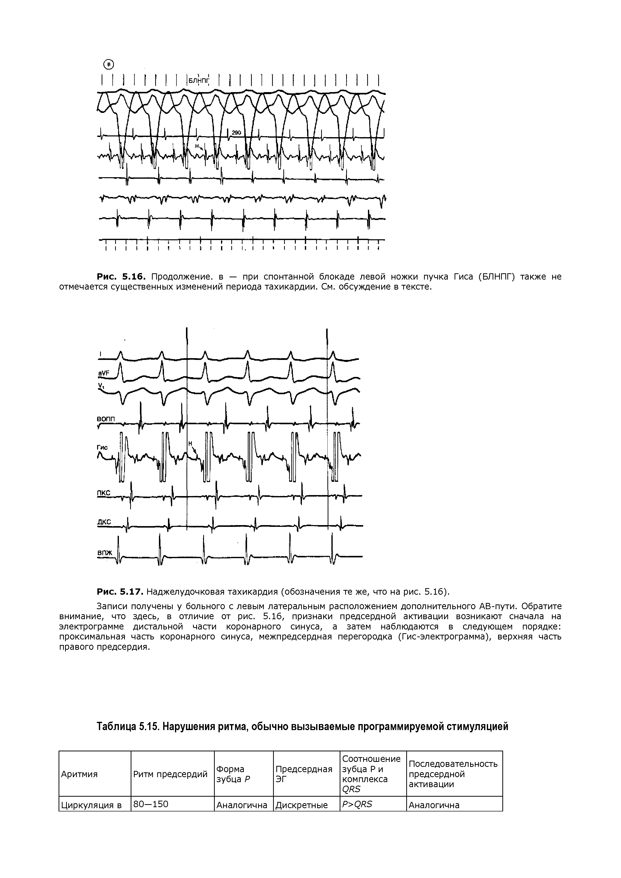 Рис. 5.16. Продолжение, в — при спонтанной блокаде левой ножки пучка Гиса (БЛНПГ) также не отмечается существенных изменений периода тахикардии. См. обсуждение в тексте.